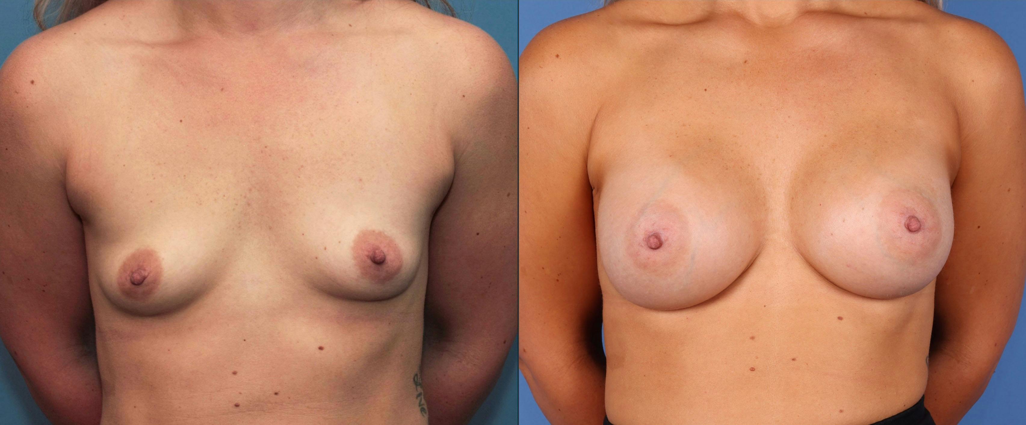 Breast Augmentation Before & After Gallery - Patient 68439649 - Image 1