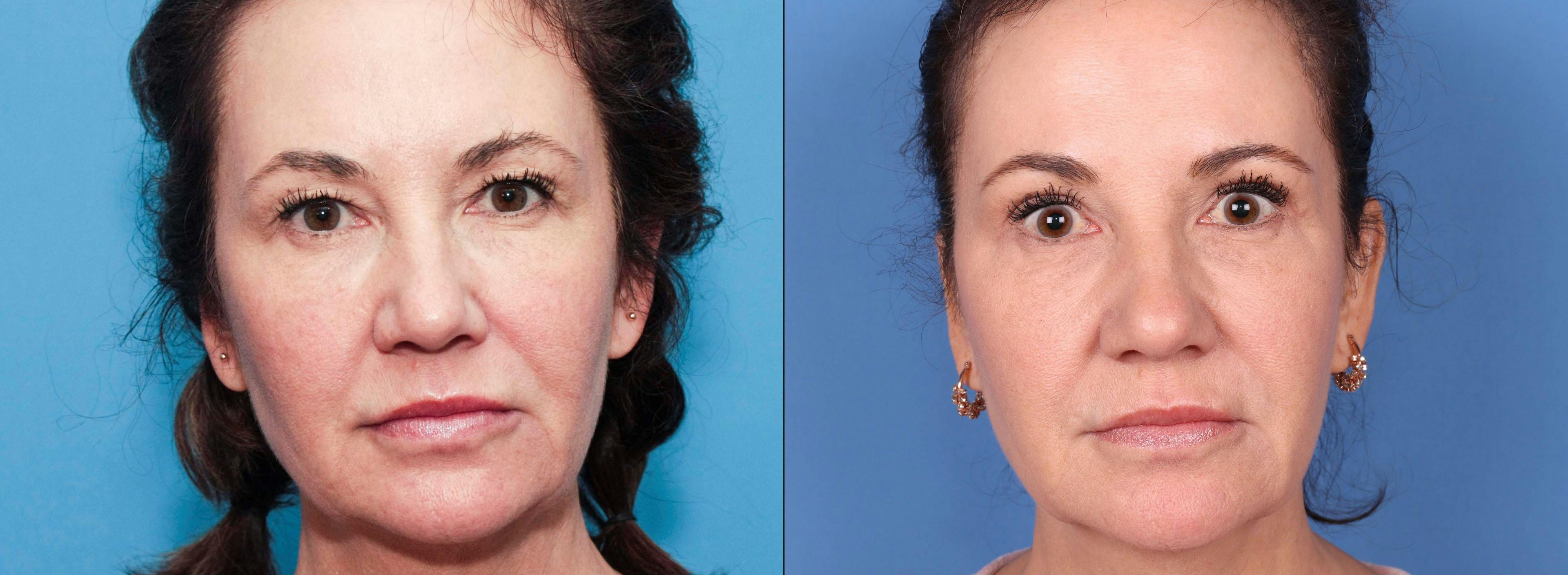 Eyelid Surgery (Blepharoplasty) Before & After Gallery - Patient 71343847 - Image 1