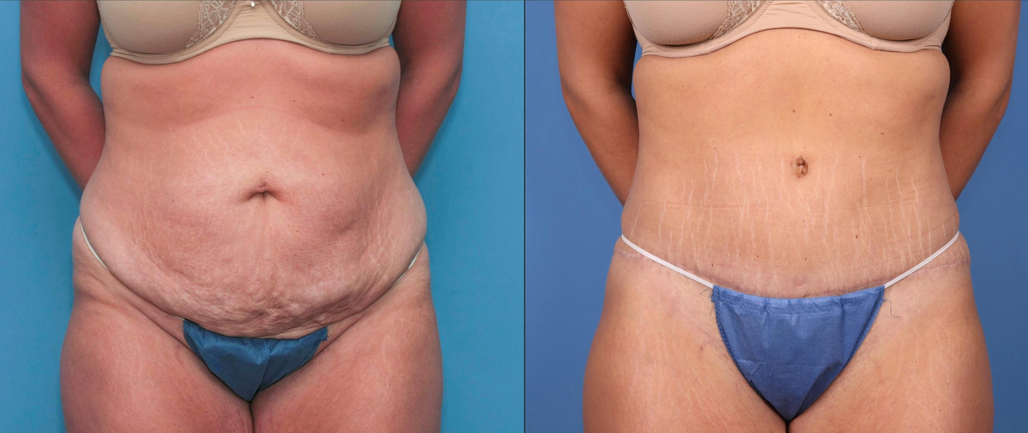 Abdomen Before & After Gallery - Patient 149385218 - Image 1