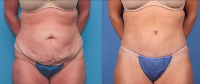 Tummy Tuck Before & After Gallery - Patient 72151125 - Image 1