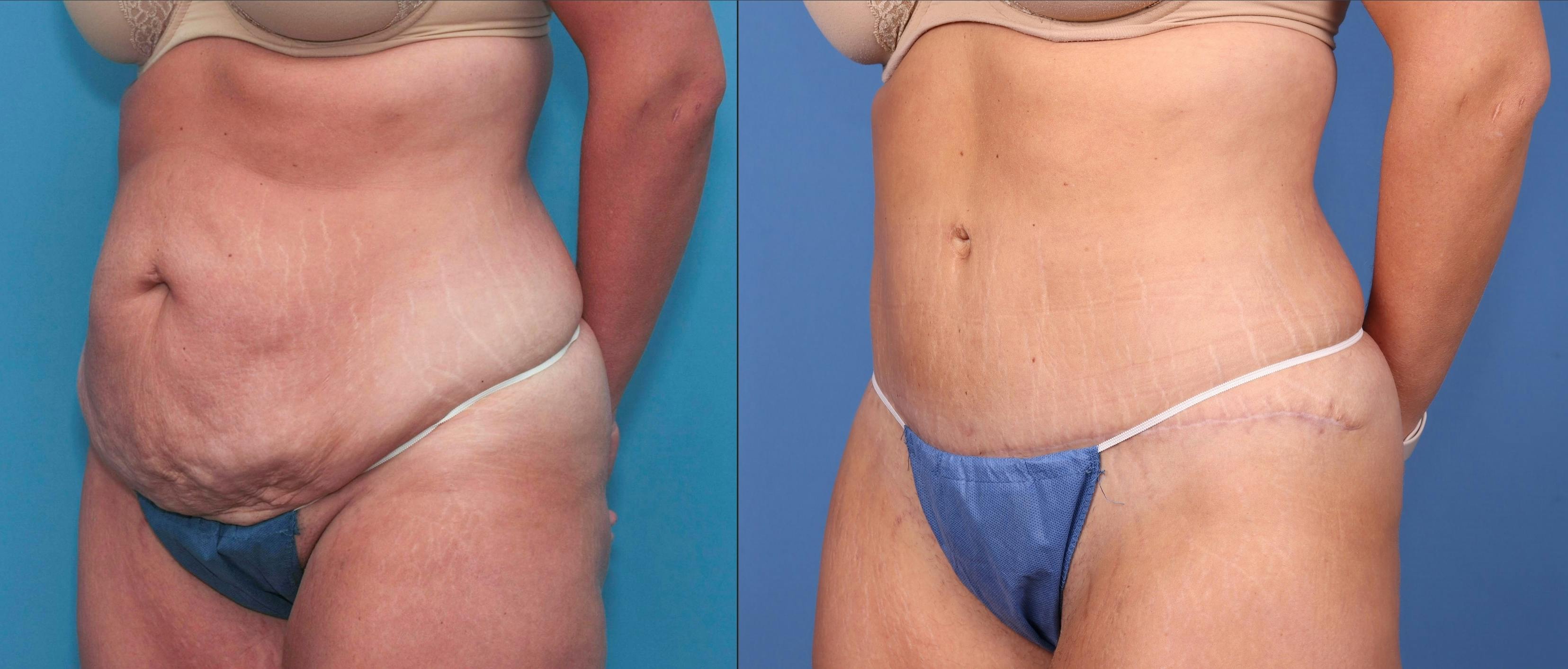 Abdomen Before & After Gallery - Patient 149385218 - Image 2