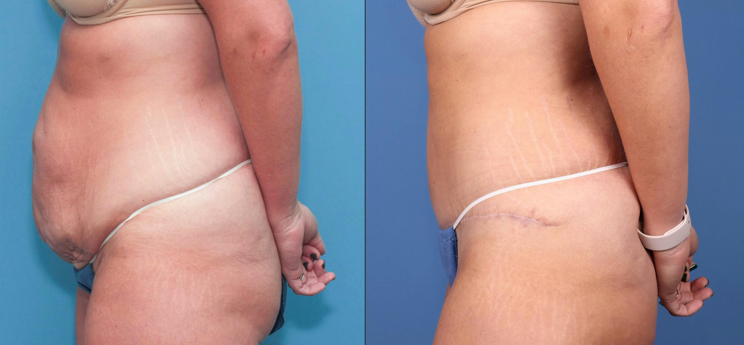 Abdomen Before & After Gallery - Patient 149385218 - Image 3