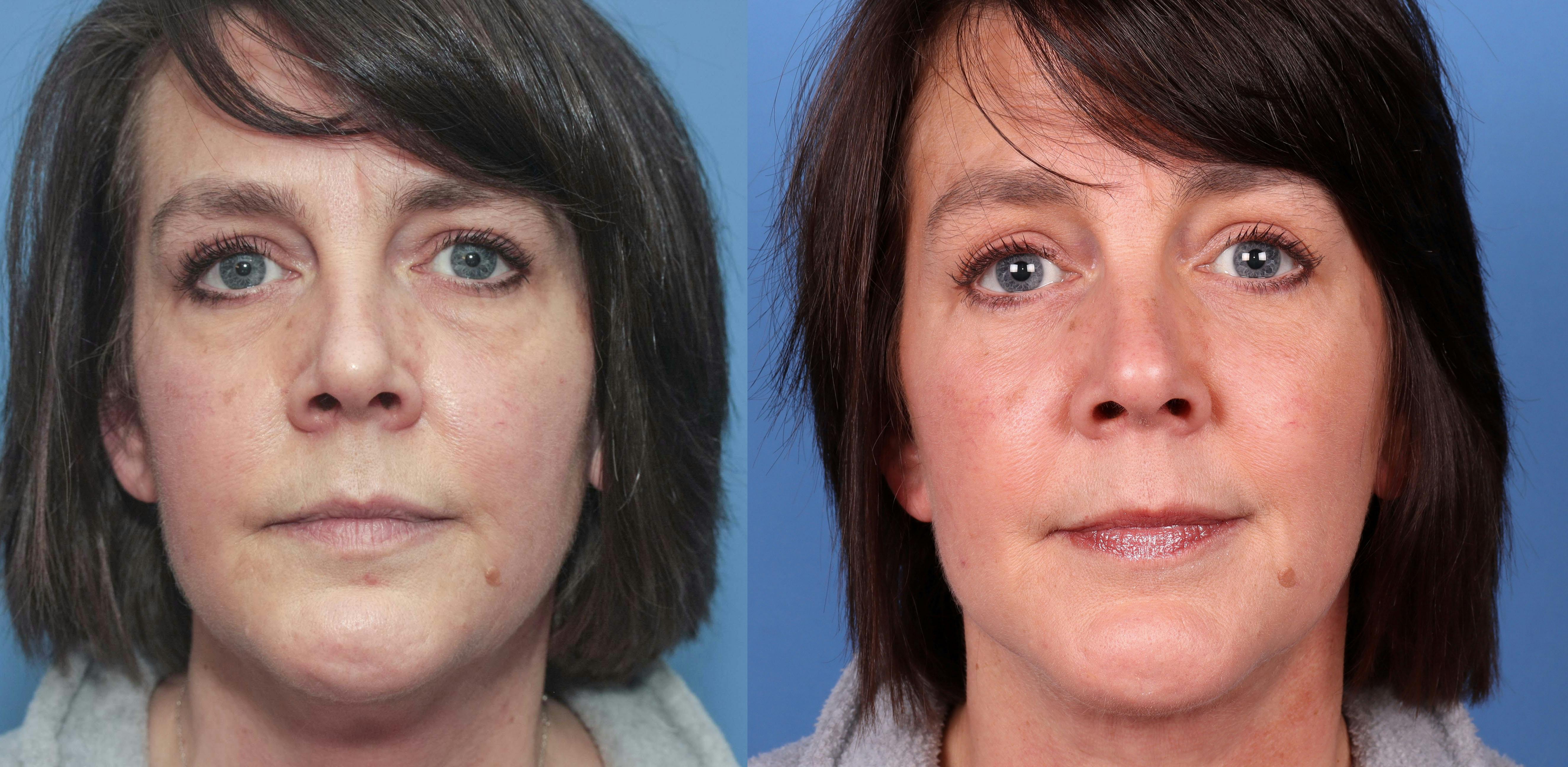 Eyelid Surgery (Lower Blepharoplasty) Before & After Gallery - Patient 879239 - Image 1