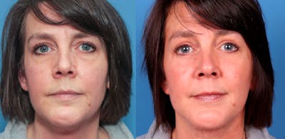 Face Lift Before & After Gallery - Patient 72155684 - Image 1