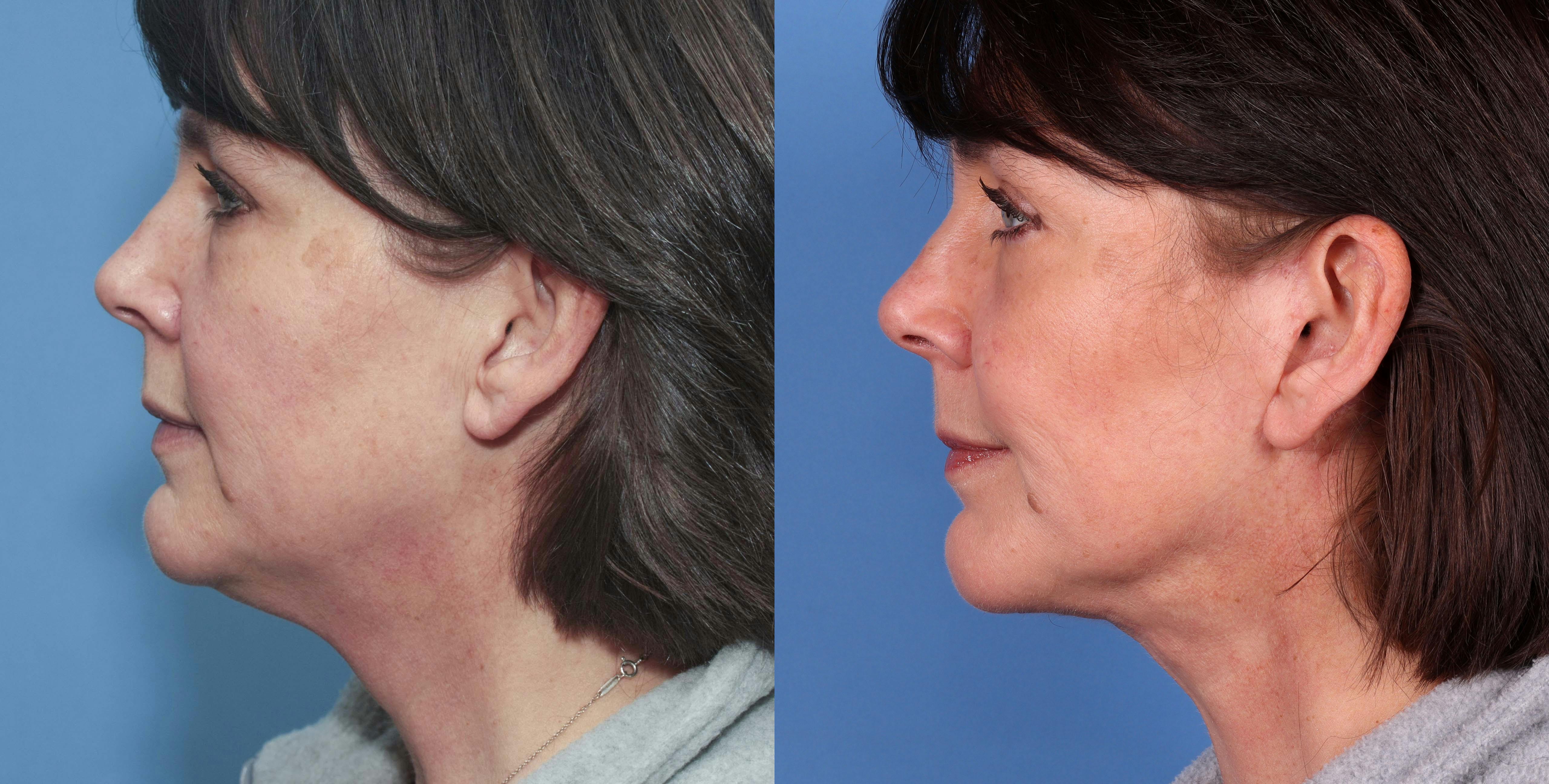 Neck Lift Before & After Gallery - Patient 72155747 - Image 2