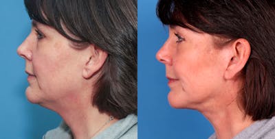 Neck Lift Before & After Gallery - Patient 72155747 - Image 1