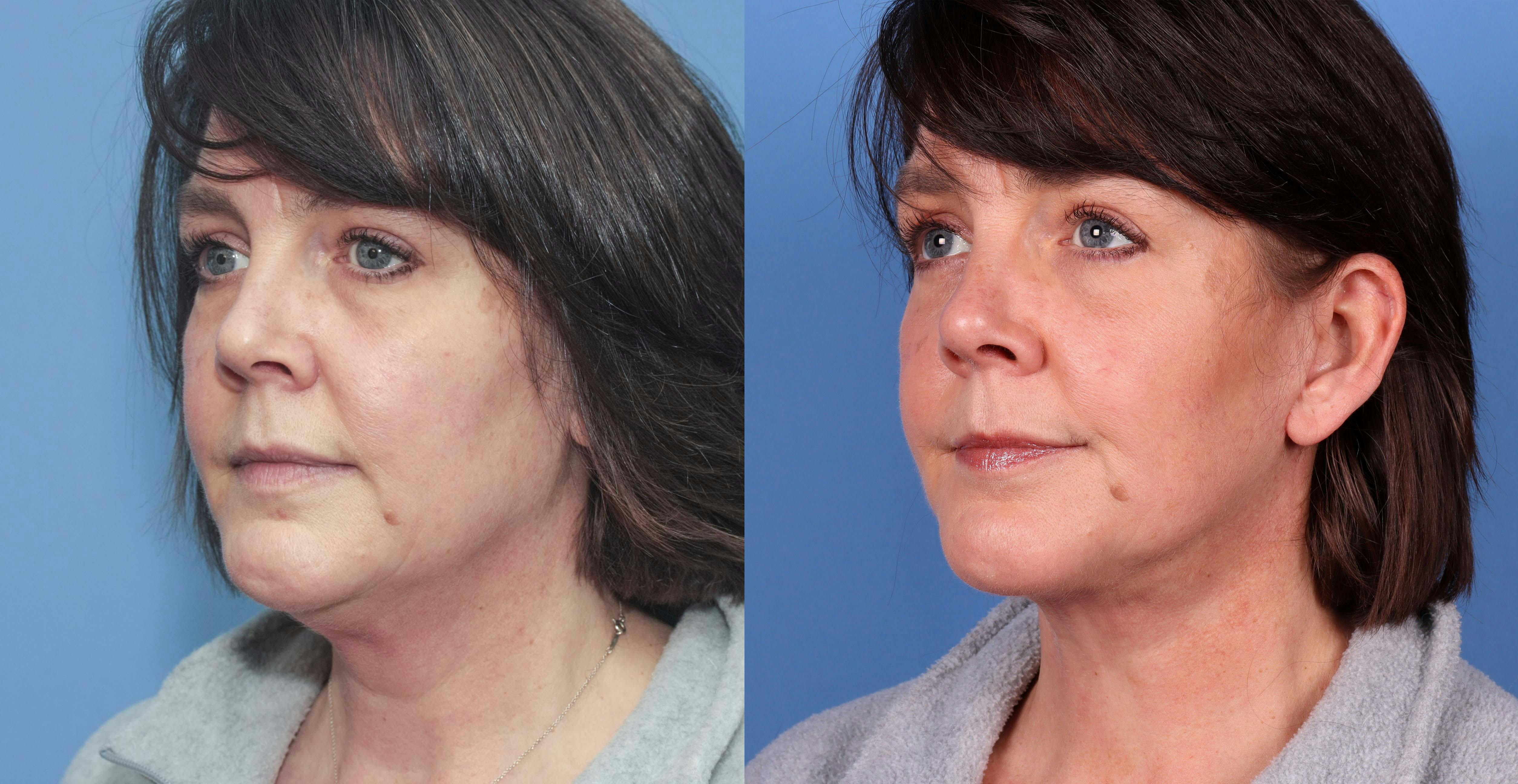 Face Lift Before & After Gallery - Patient 72155684 - Image 3