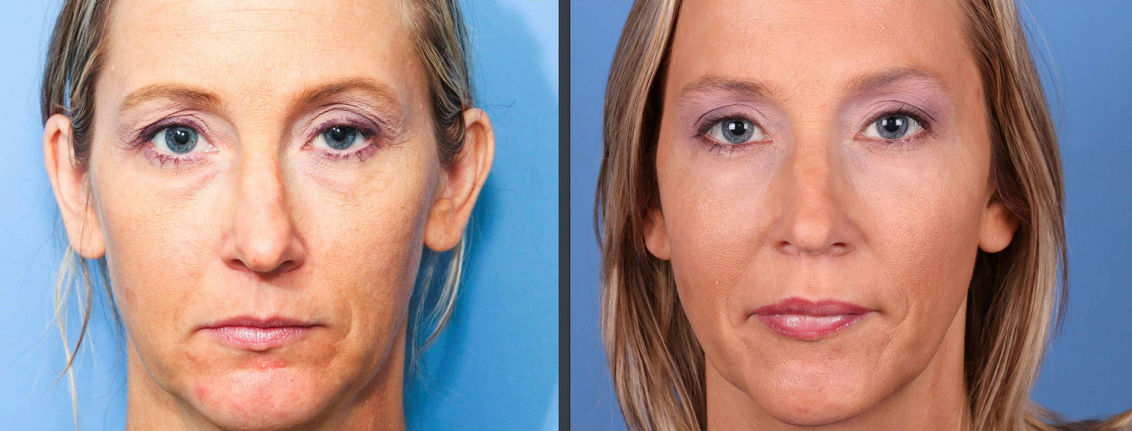 Facial Fillers Before & After Gallery - Patient 72155844 - Image 1