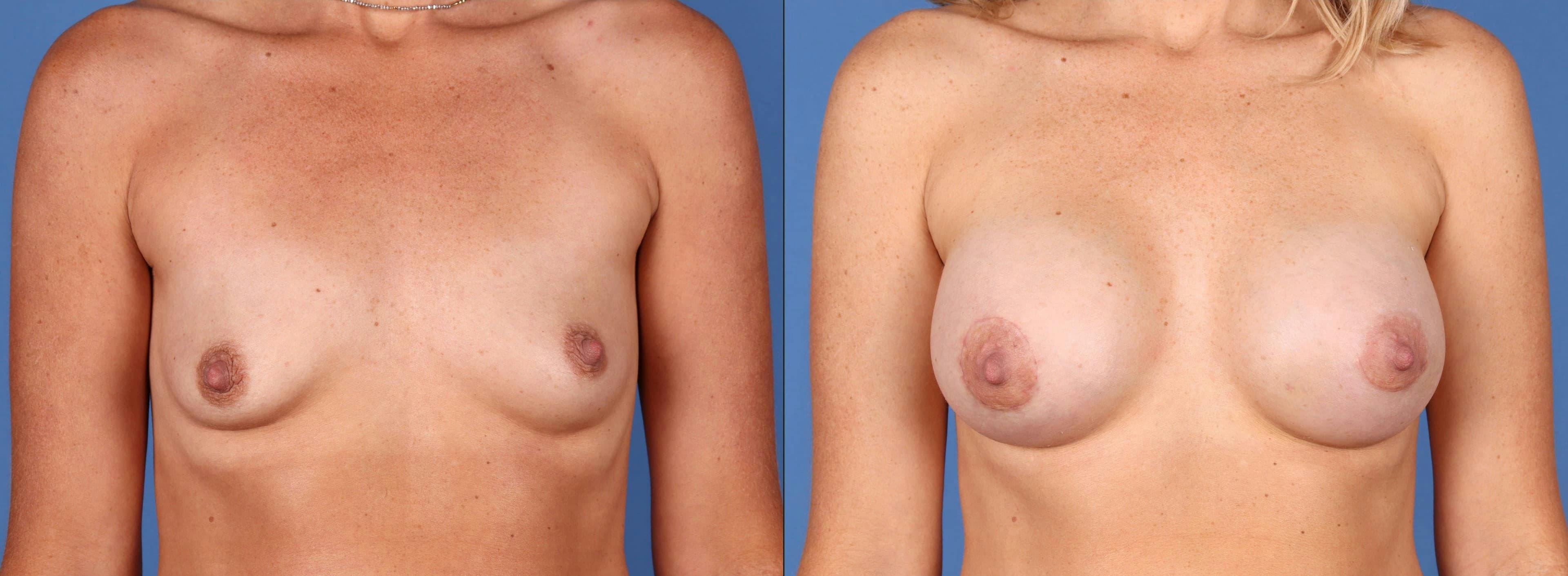 Breast Revision Before & After Gallery - Patient 74009020 - Image 1