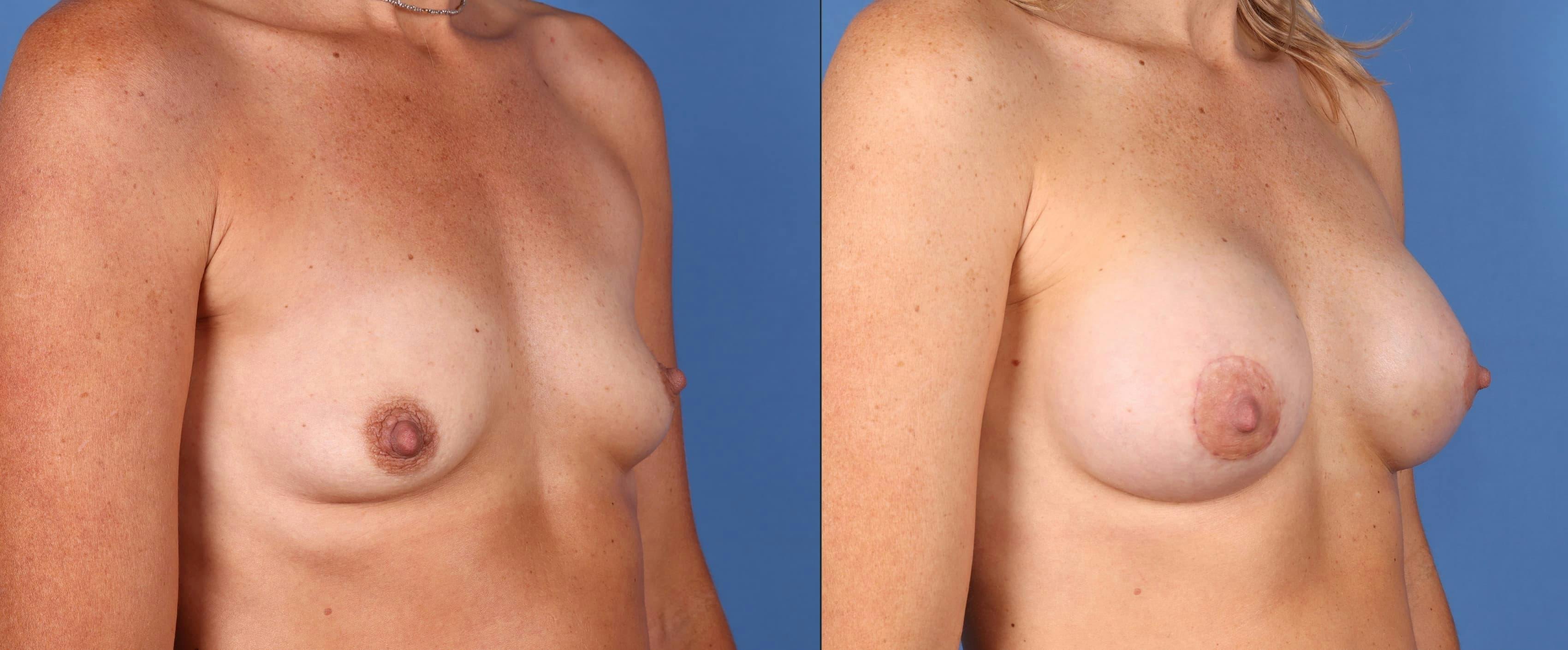 Breast Revision Before & After Gallery - Patient 74009020 - Image 2