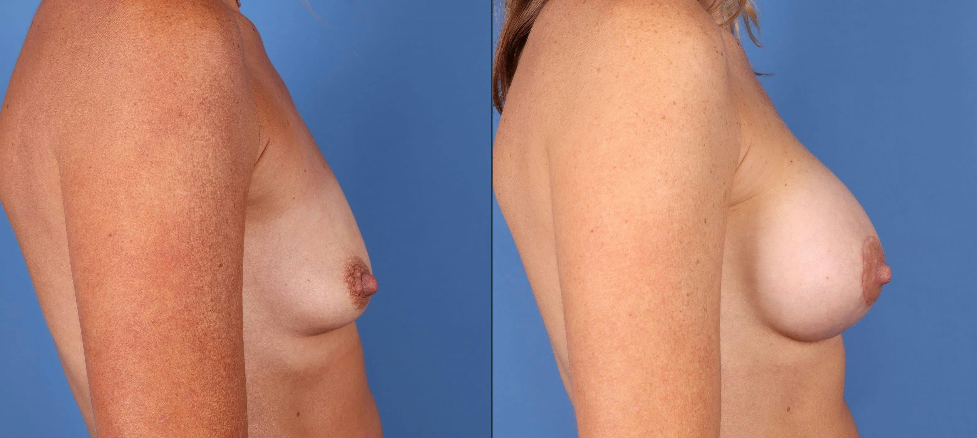 Breast Revision Before & After Gallery - Patient 74009020 - Image 3