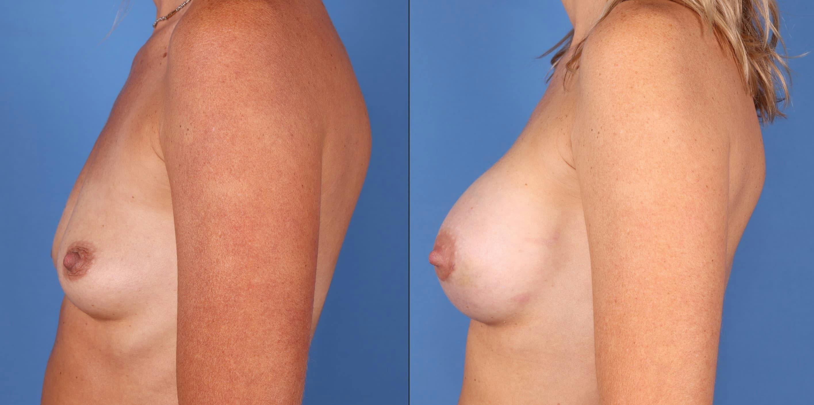 Breast Revision Before & After Gallery - Patient 74009020 - Image 5