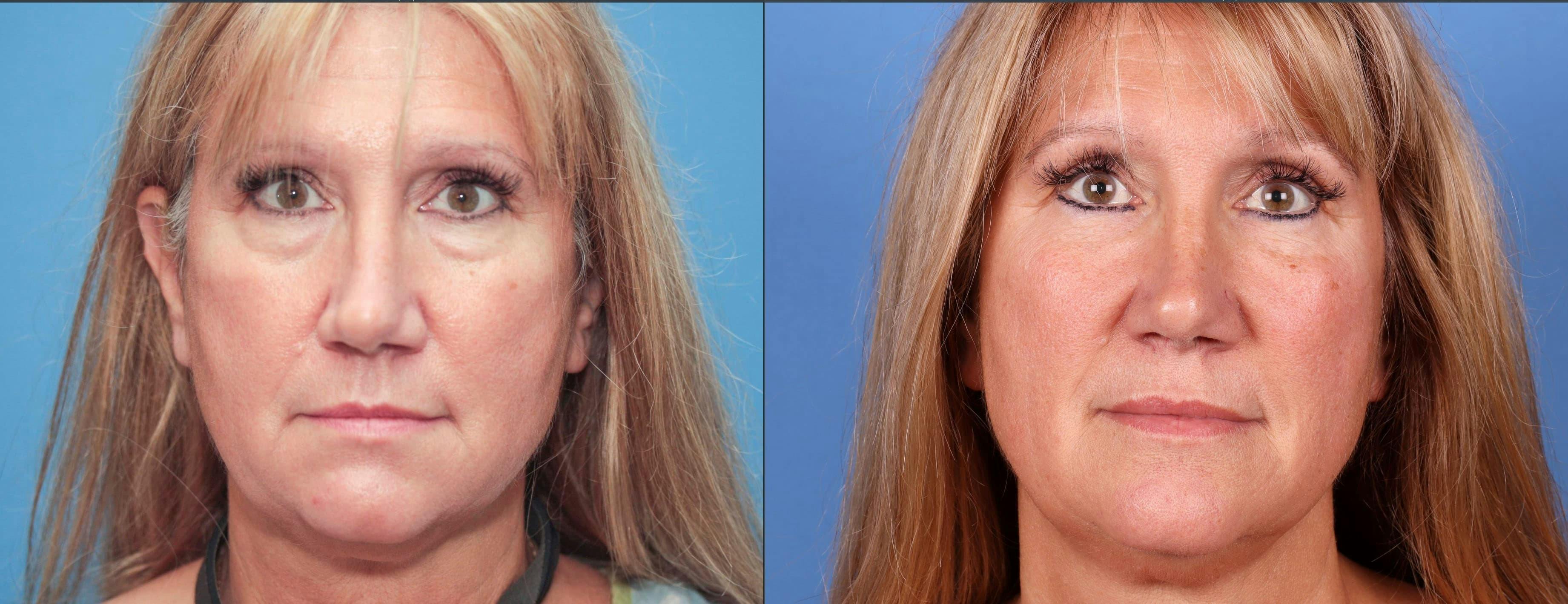 Eyelid Surgery (Upper & Lower Blepharoplasty) Before & After Gallery - Patient 497335 - Image 1