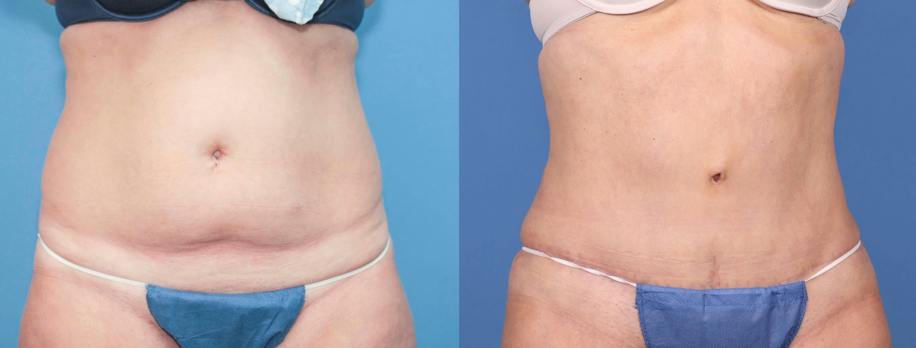 Abdomen Before & After Gallery - Patient 149385217 - Image 1