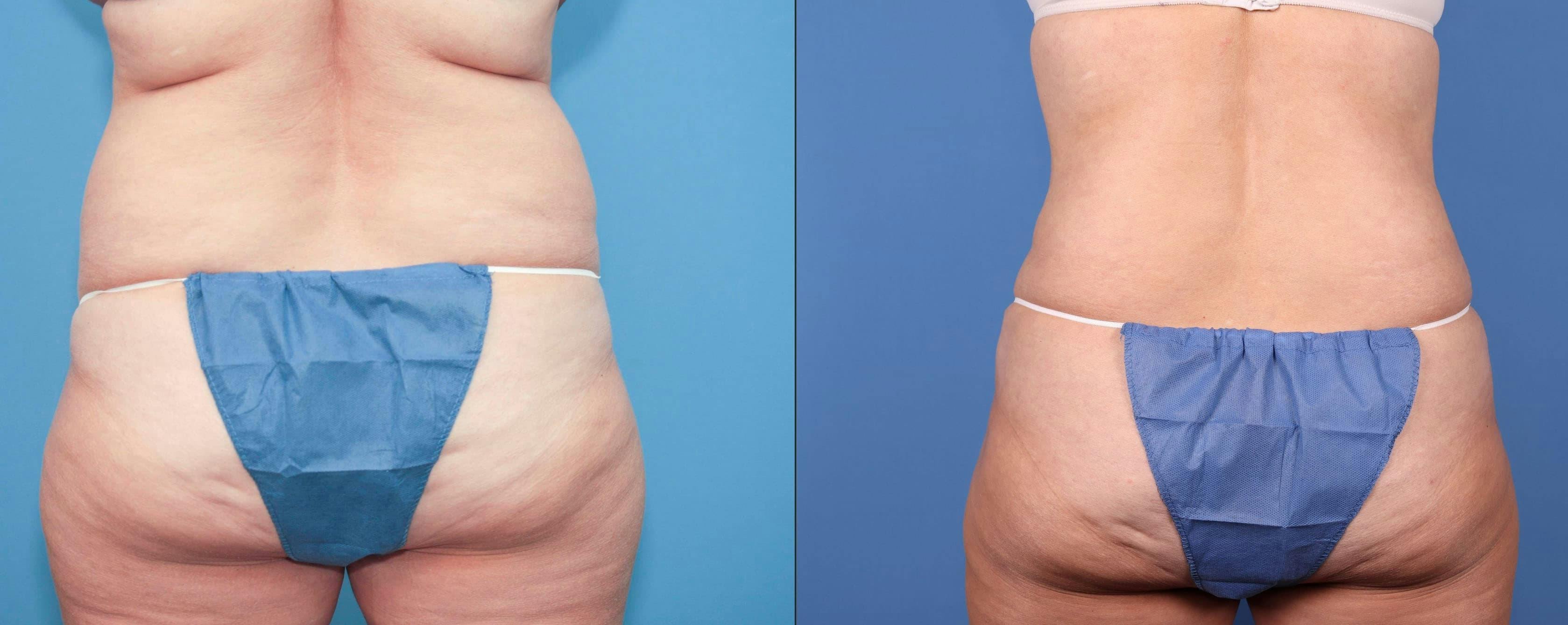 Abdomen Before & After Gallery - Patient 149385217 - Image 3