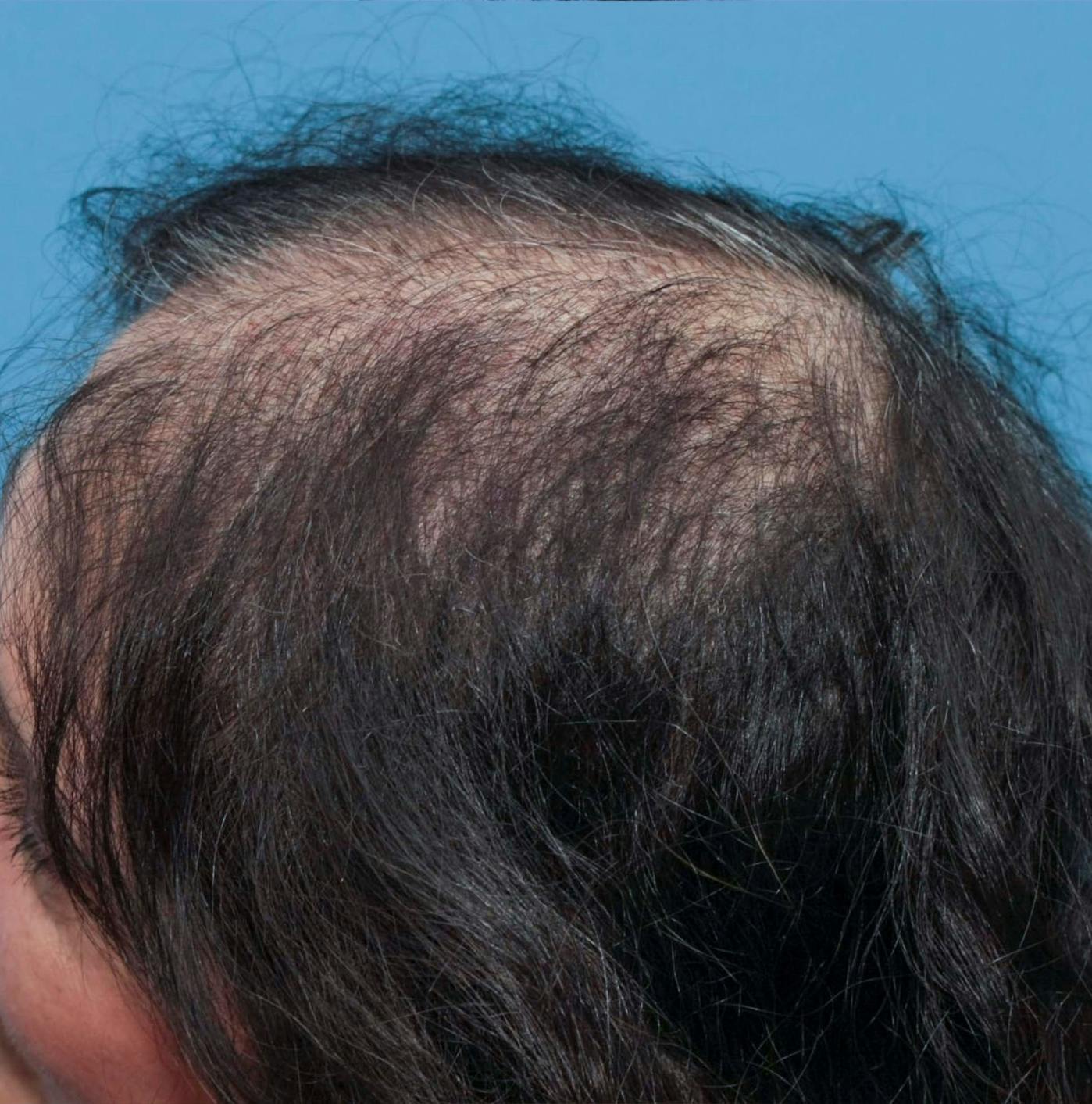 Female Hair Restoration Before & After Gallery - Patient 131385333 - Image 5