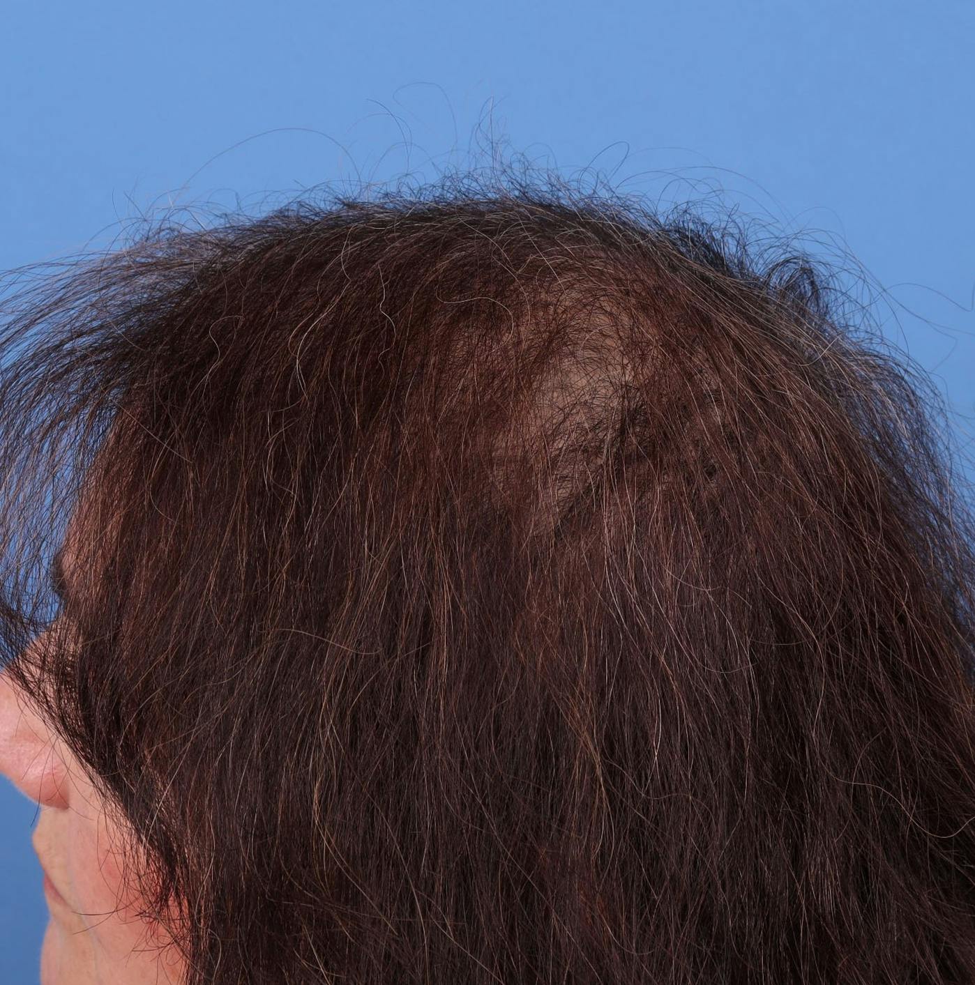 Female Hair Restoration Before & After Gallery - Patient 131385333 - Image 6