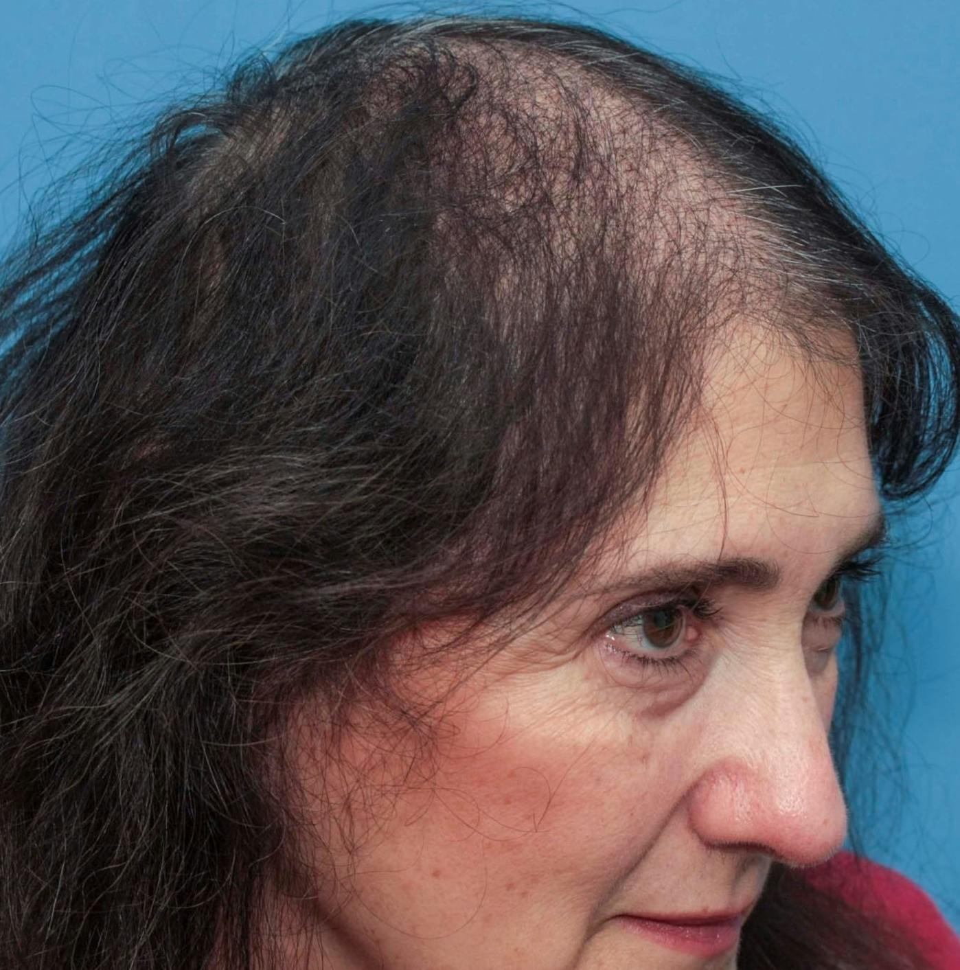 NeoGraft Hair Restoration Before & After Gallery - Patient 74769213 - Image 7