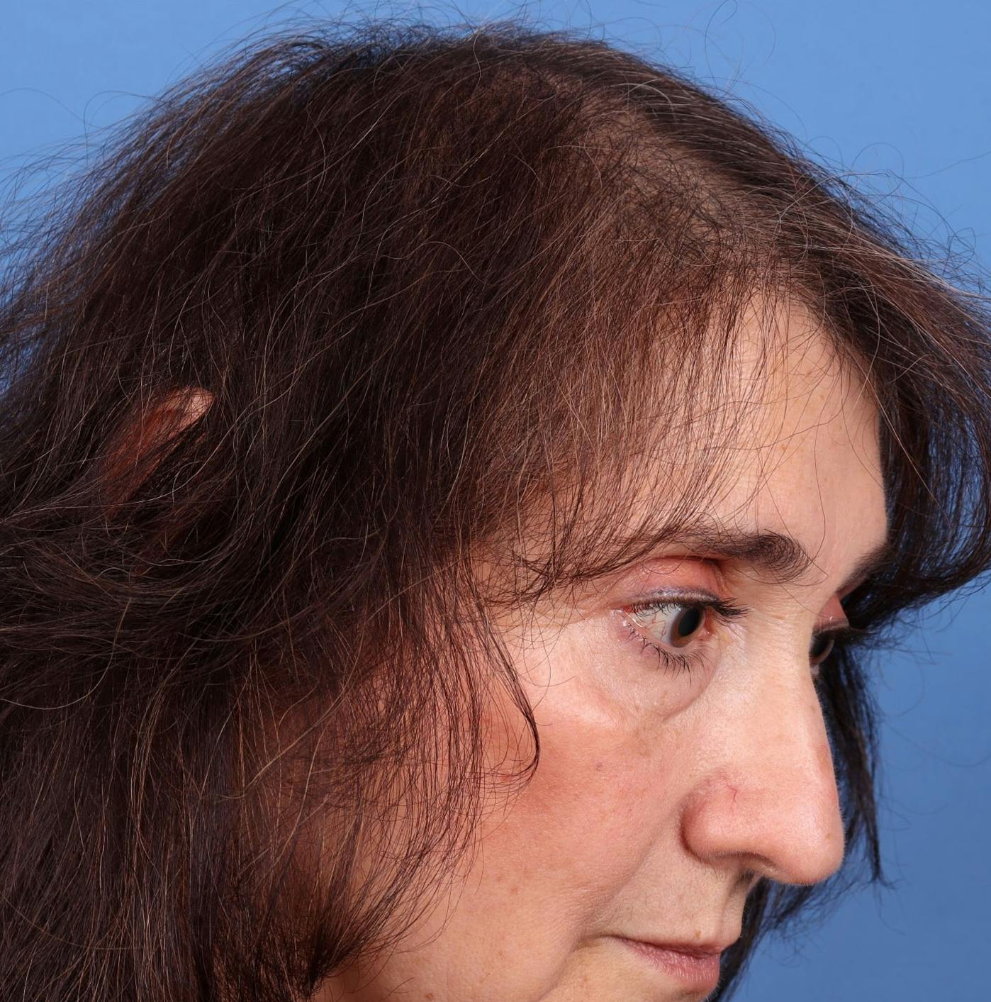 Female Hair Restoration Before & After Gallery - Patient 131385333 - Image 8
