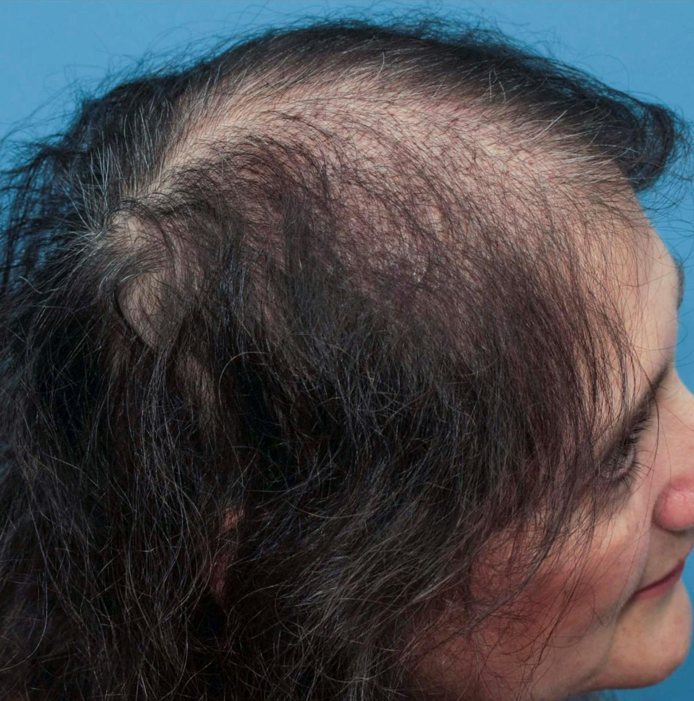 Female Hair Restoration Before & After Gallery - Patient 131385333 - Image 9