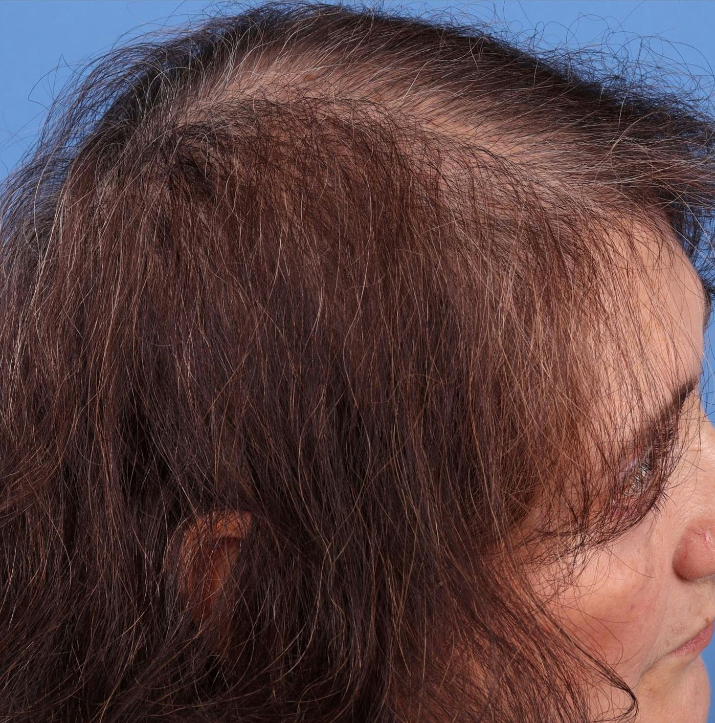 Female Hair Restoration Before & After Gallery - Patient 131385333 - Image 10
