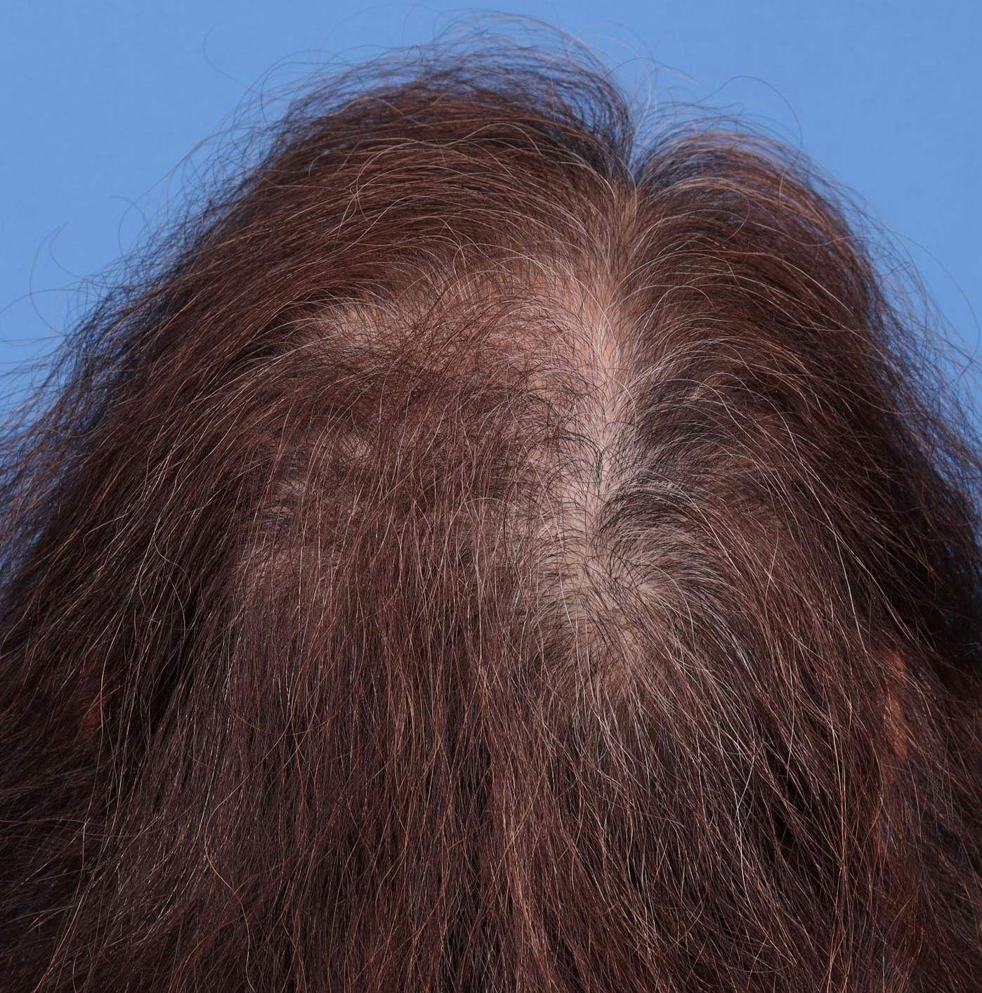 Female Hair Restoration Before & After Gallery - Patient 131385333 - Image 12