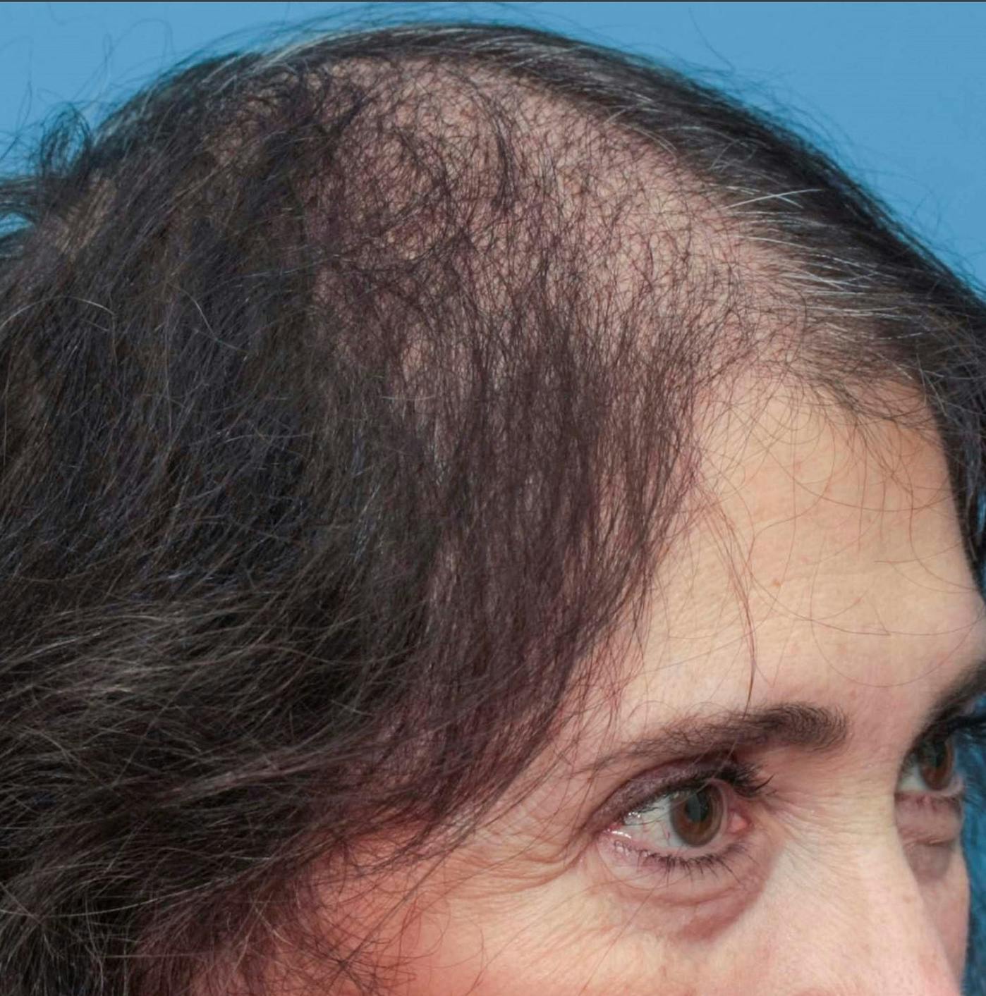 Female Hair Restoration Before & After Gallery - Patient 131385333 - Image 13