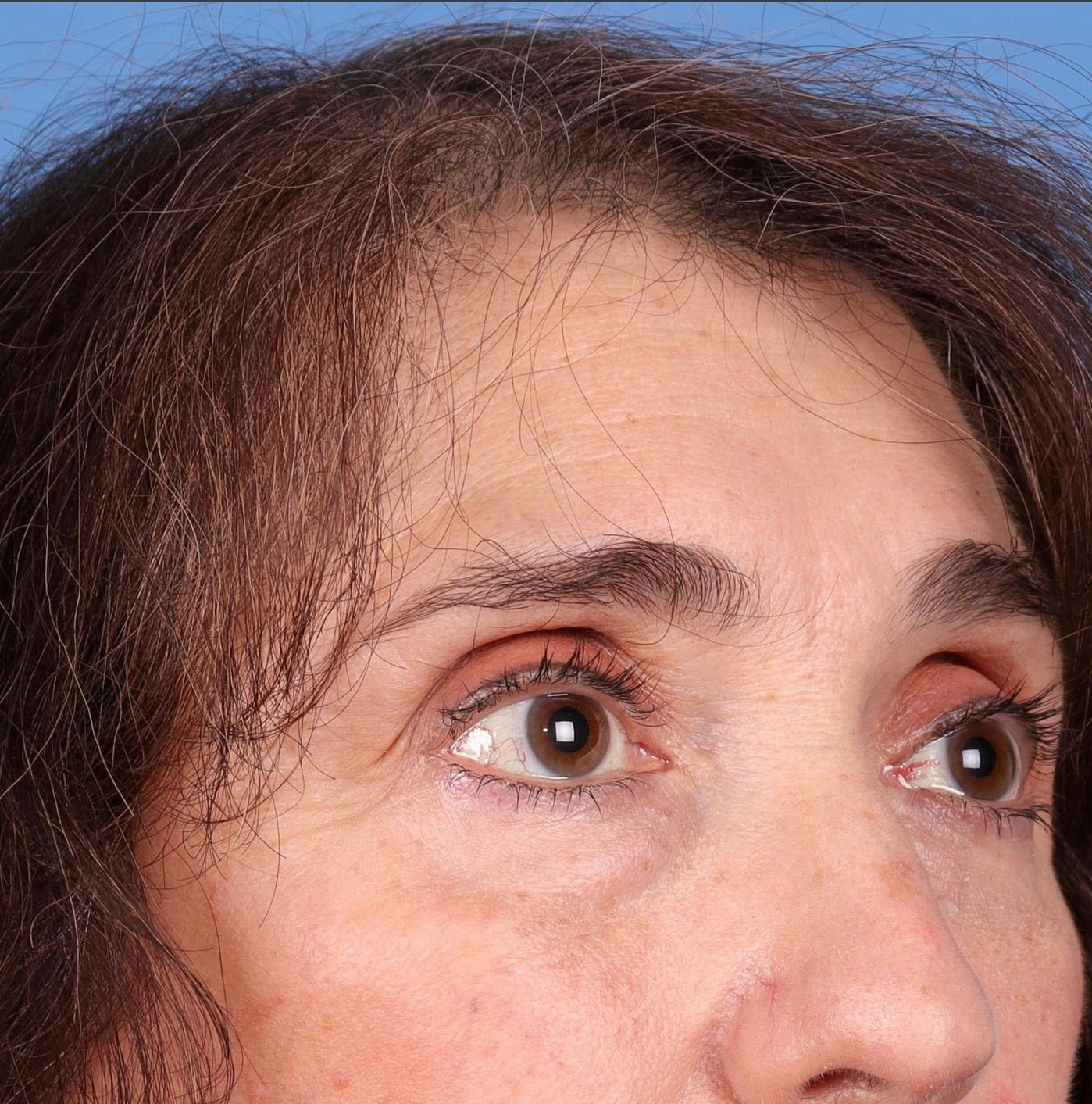 Female Hair Restoration Before & After Gallery - Patient 131385333 - Image 14