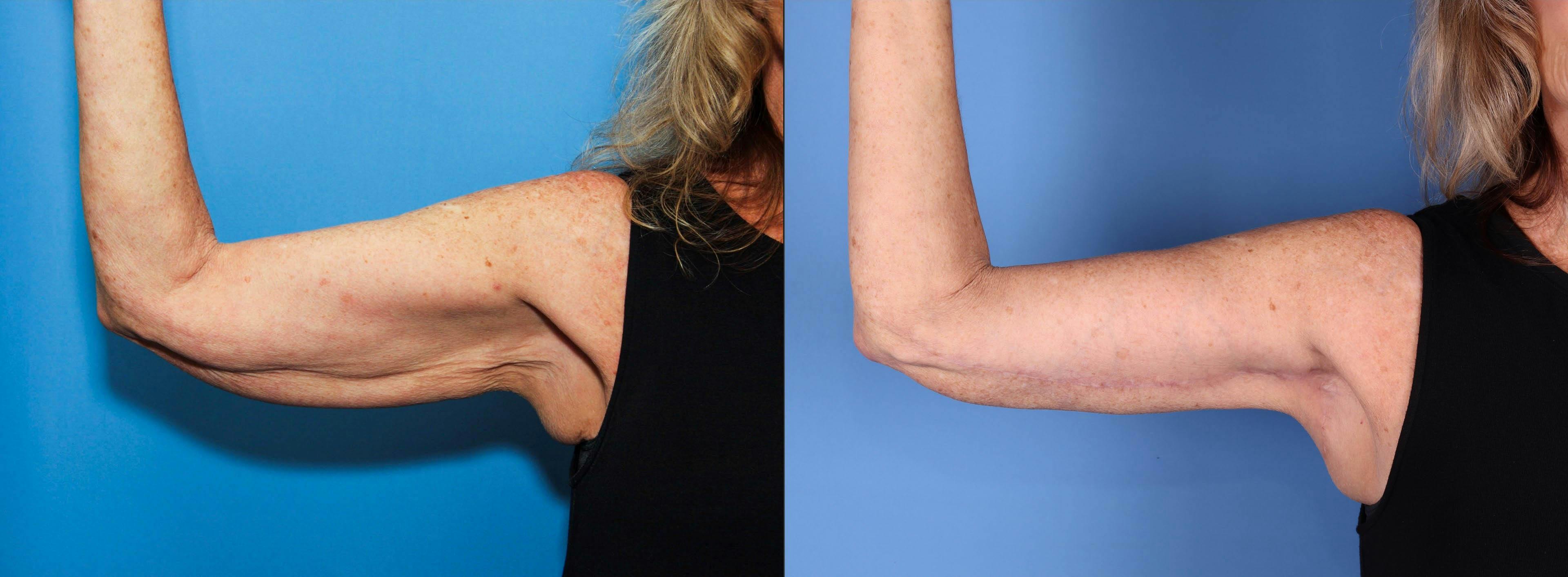 Arm Lift Before & After Gallery - Patient 77175810 - Image 1