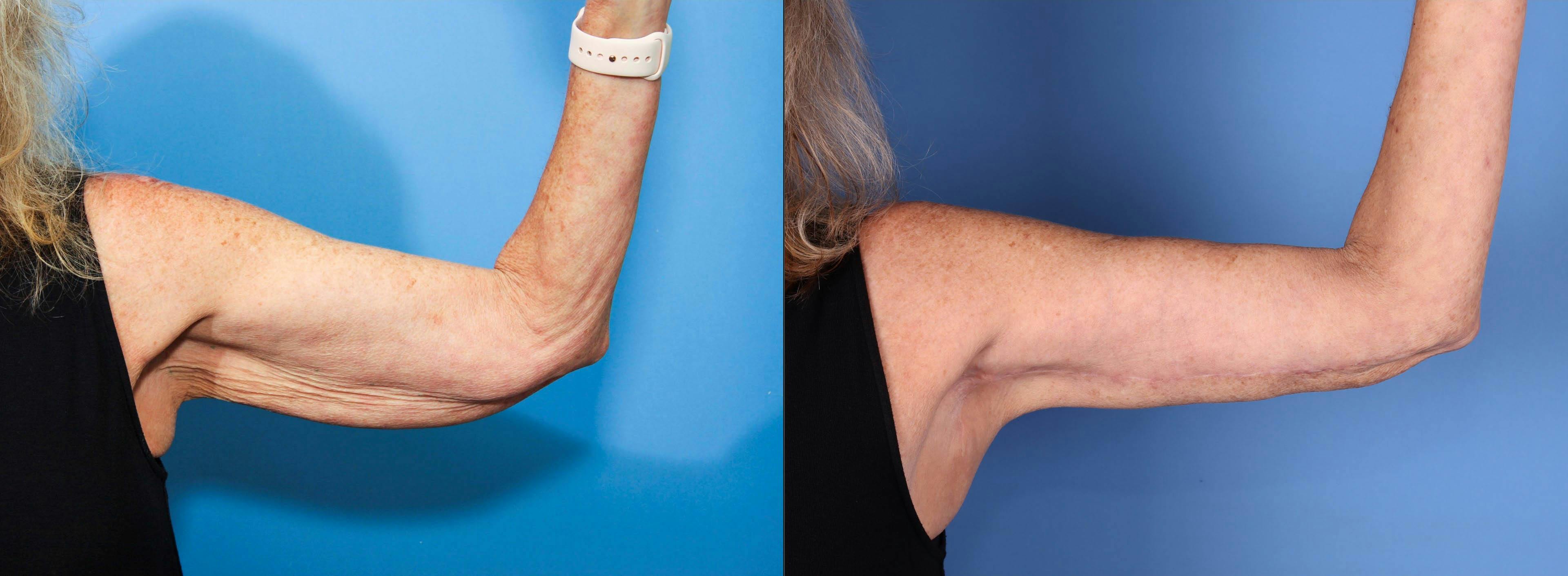 Arm Lift Before & After Gallery - Patient 157889 - Image 2