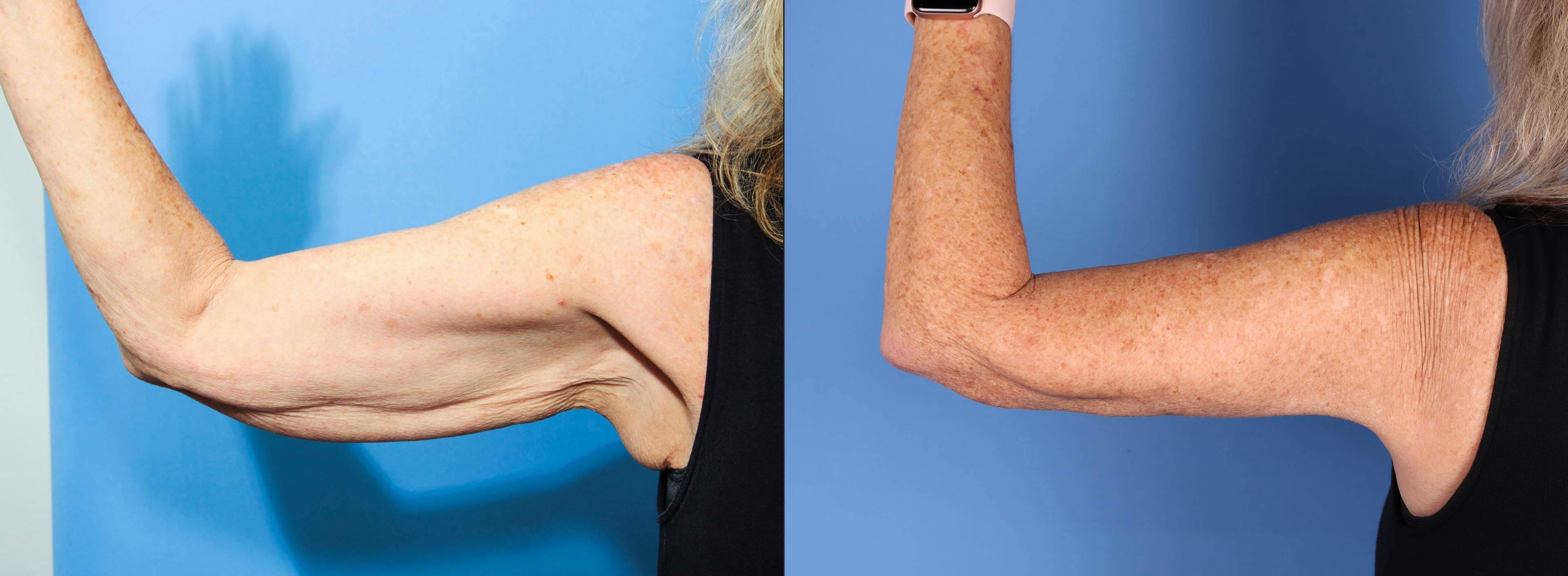 Arm Lift Before & After Gallery - Patient 157889 - Image 3