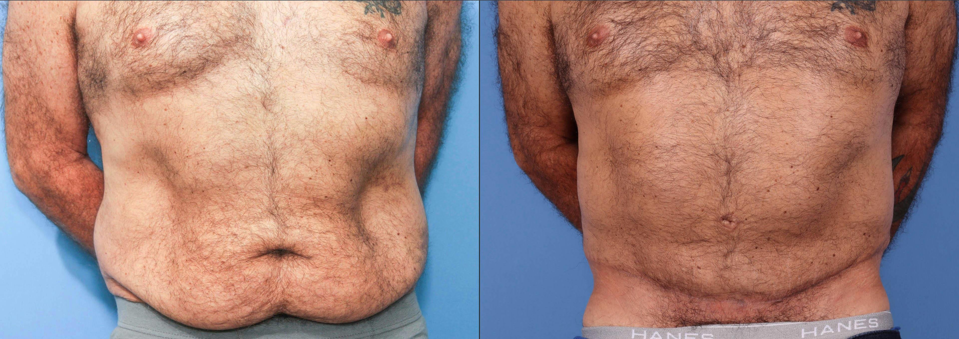 Abdomen Before & After Gallery - Patient 149385215 - Image 1