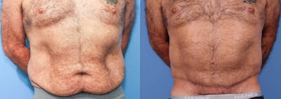 Abdomen Before & After Gallery - Patient 149385215 - Image 1