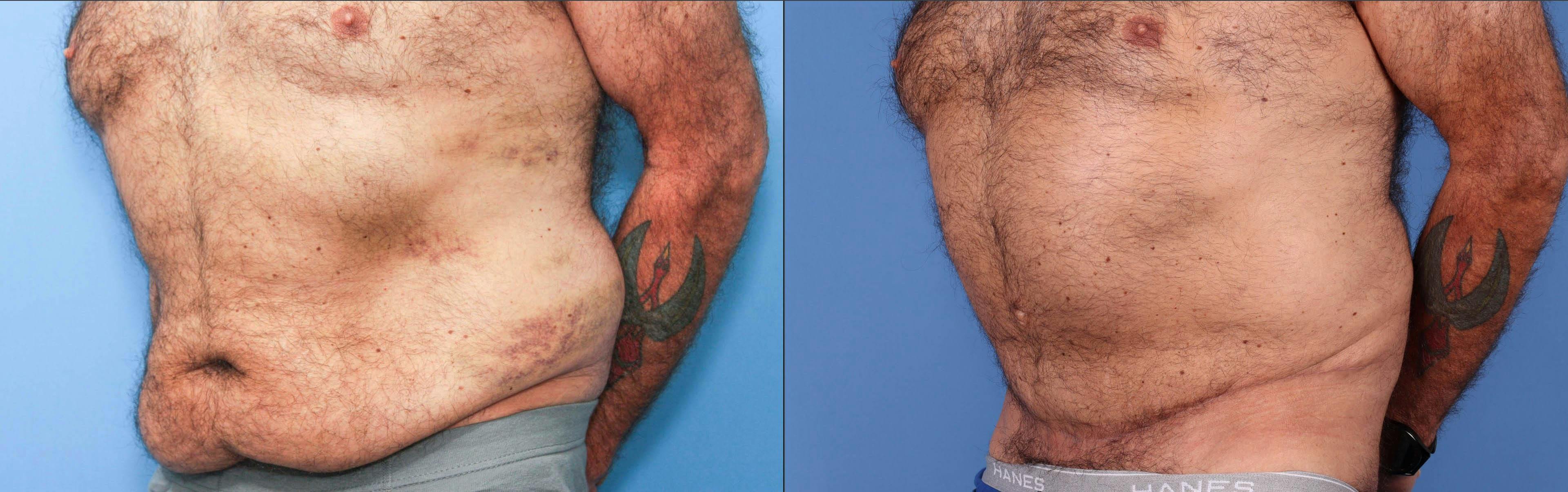 Abdomen Before & After Gallery - Patient 149385215 - Image 2