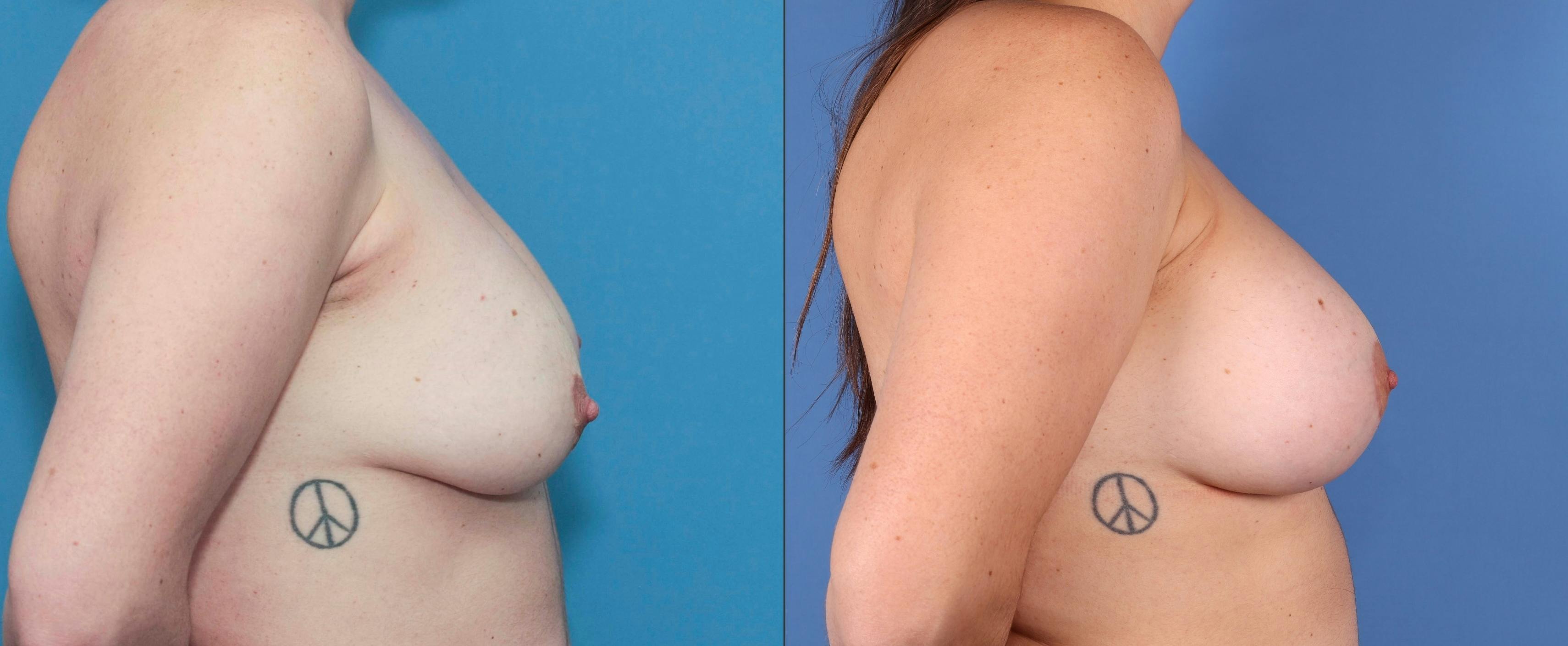 Breast Lift with Augmentation Before & After Gallery - Patient 83068585 - Image 2
