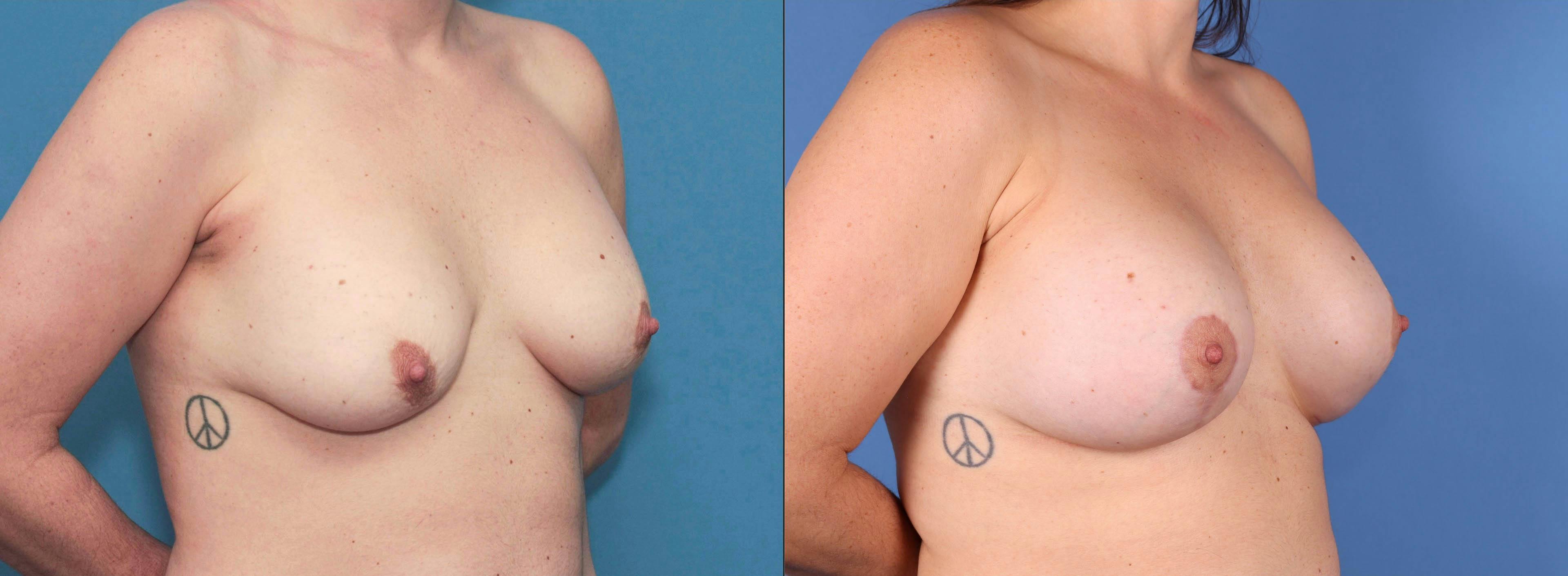 Breast Lift with Augmentation Before & After Gallery - Patient 83068585 - Image 3