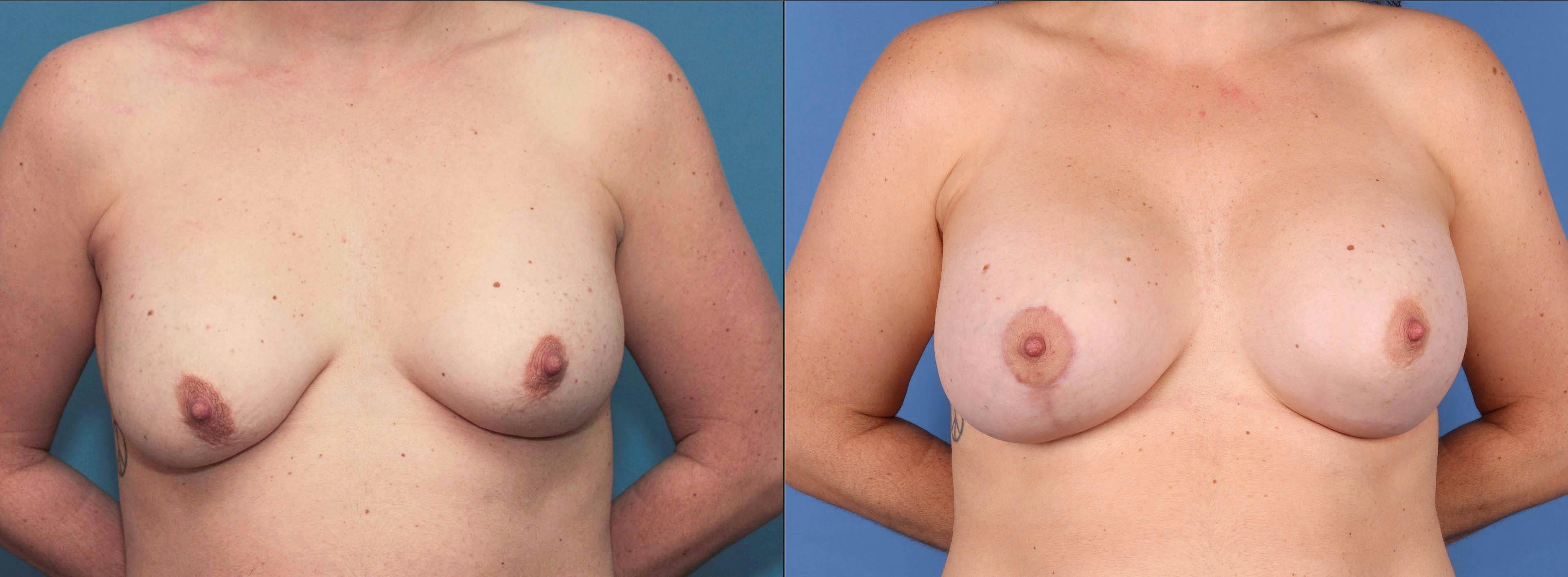 Breast Revision Before & After Gallery - Patient 83056822 - Image 1