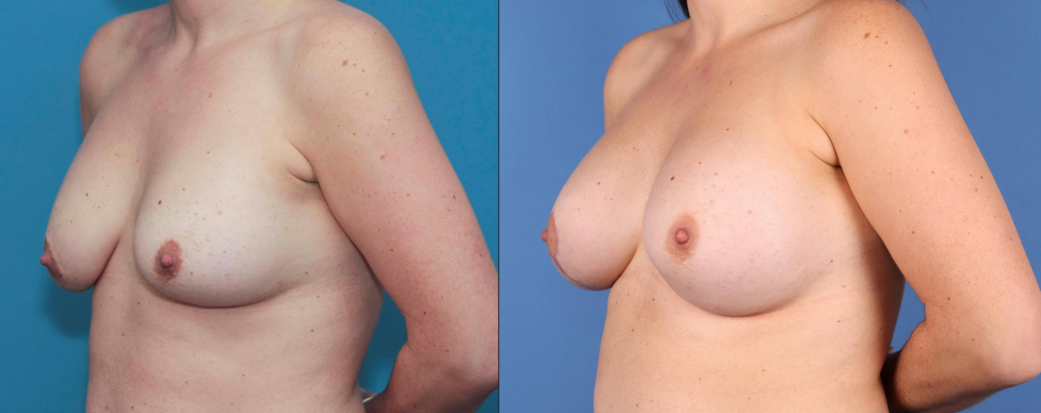 Breast Lift with Augmentation Before & After Gallery - Patient 83068585 - Image 4
