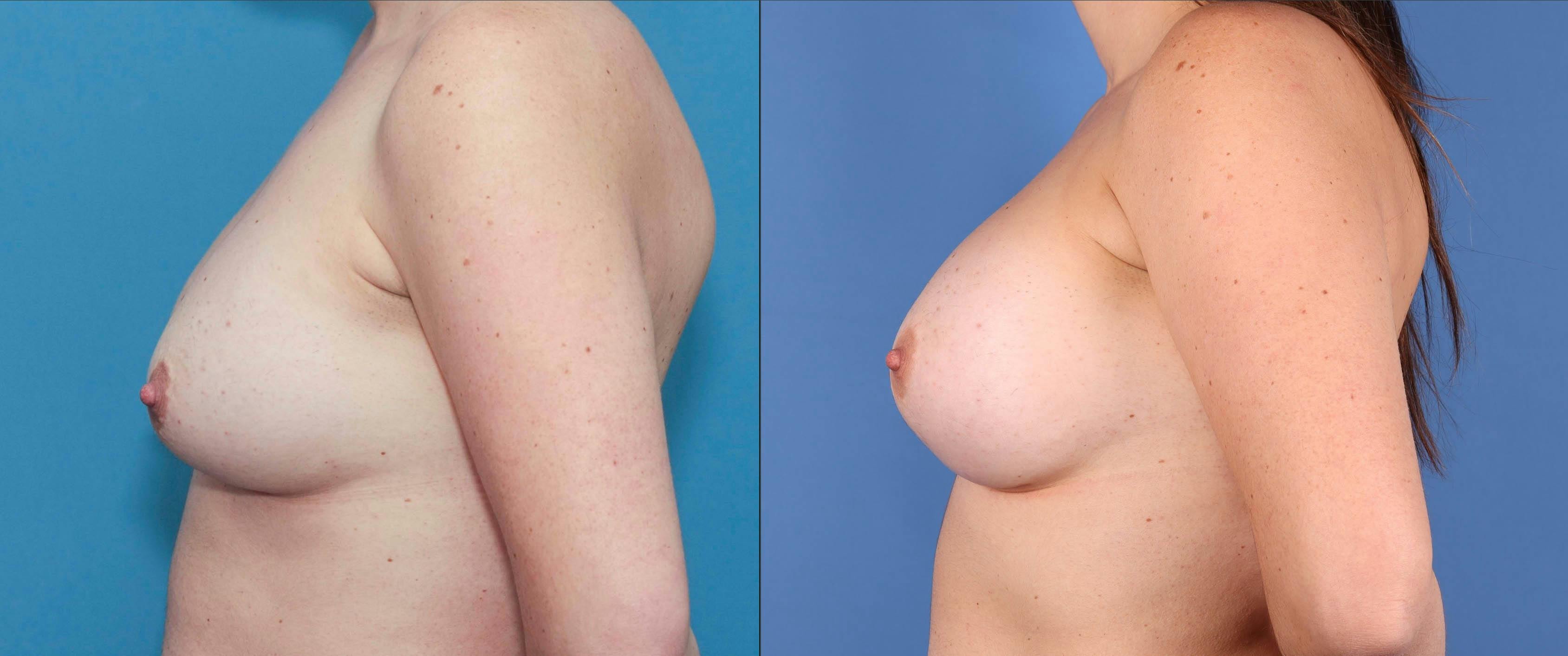 Breast Lift with Augmentation Gallery - Patient 83068585 - Image 5