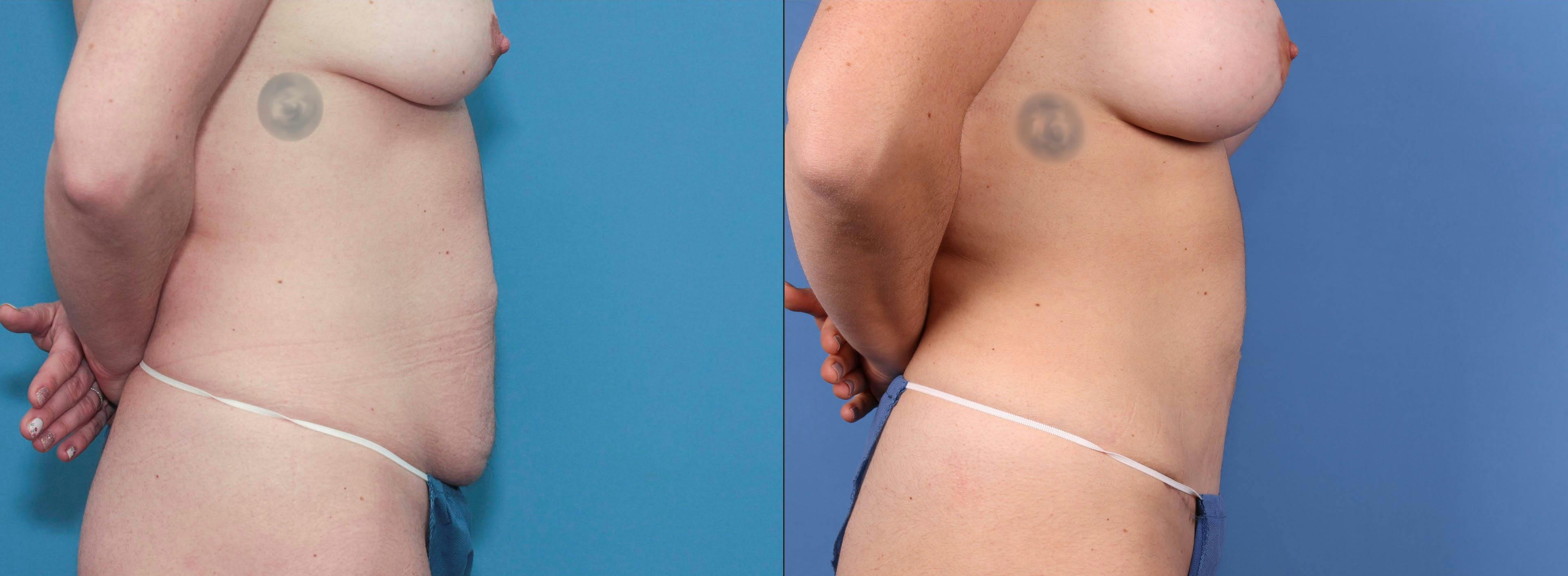 Mini Tummy Tuck Before & After Gallery - Patient 83015290 - Image 3