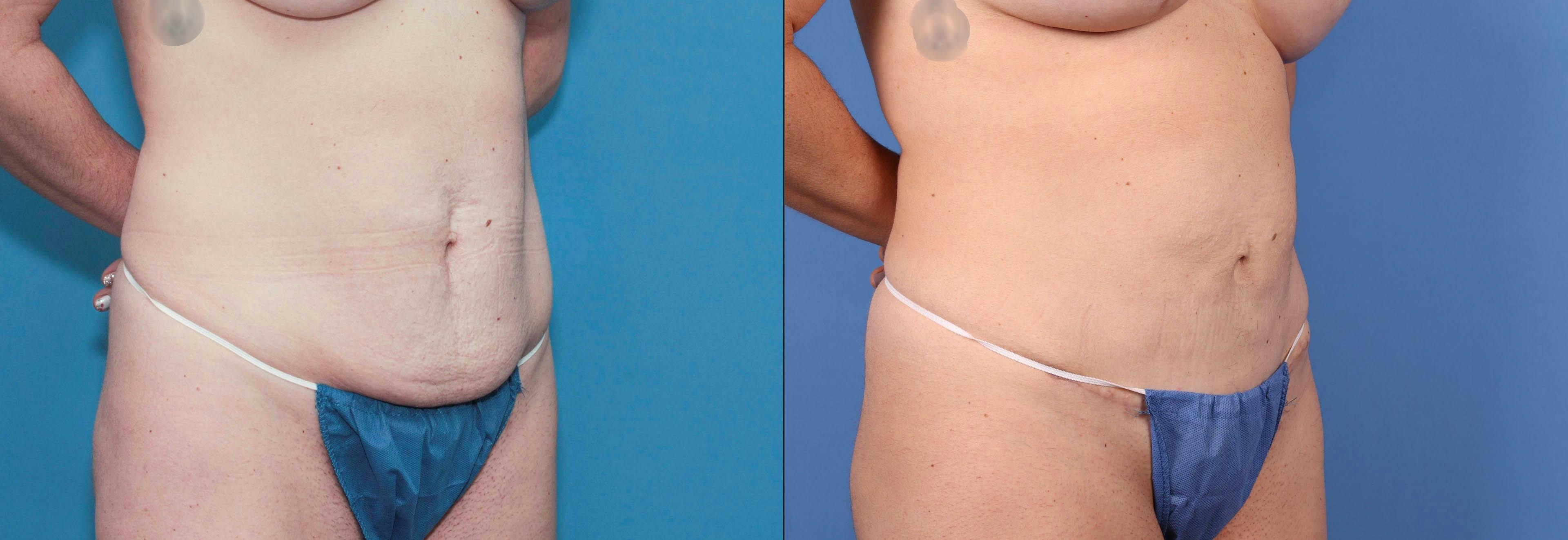Mini Tummy Tuck Before & After Gallery - Patient 83015290 - Image 2