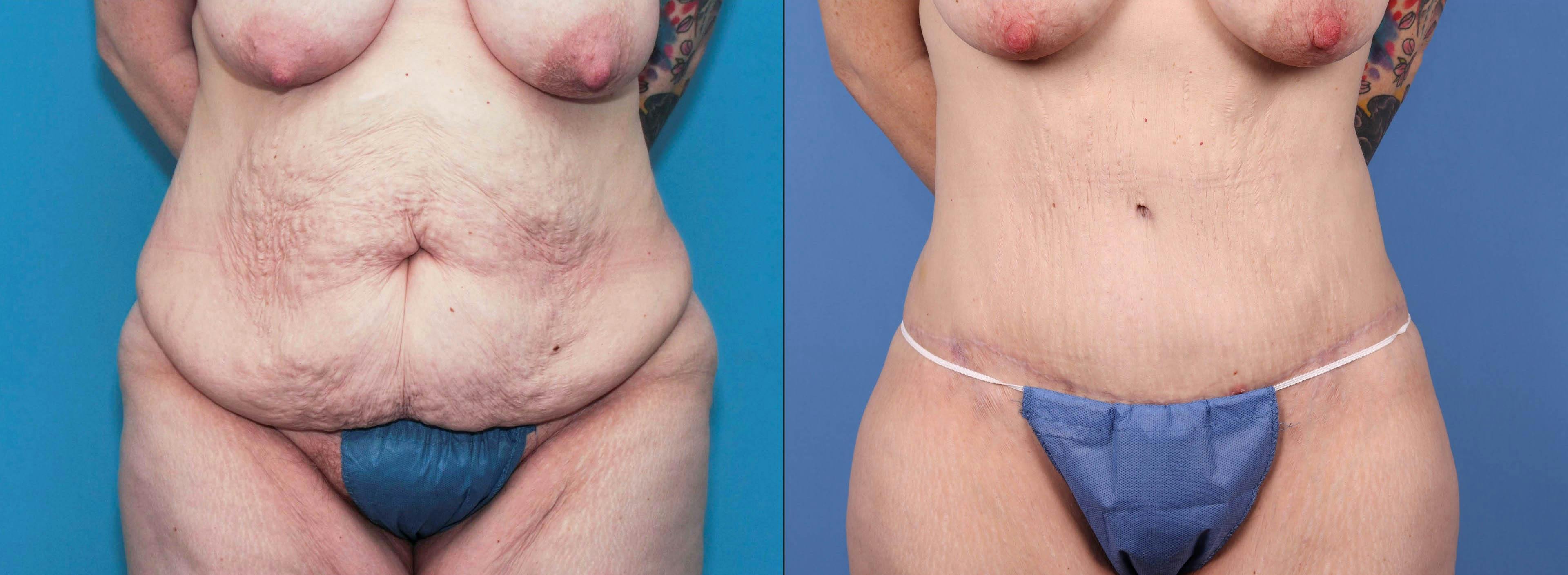 Tummy Tuck Before & After Gallery - Patient 84271116 - Image 1