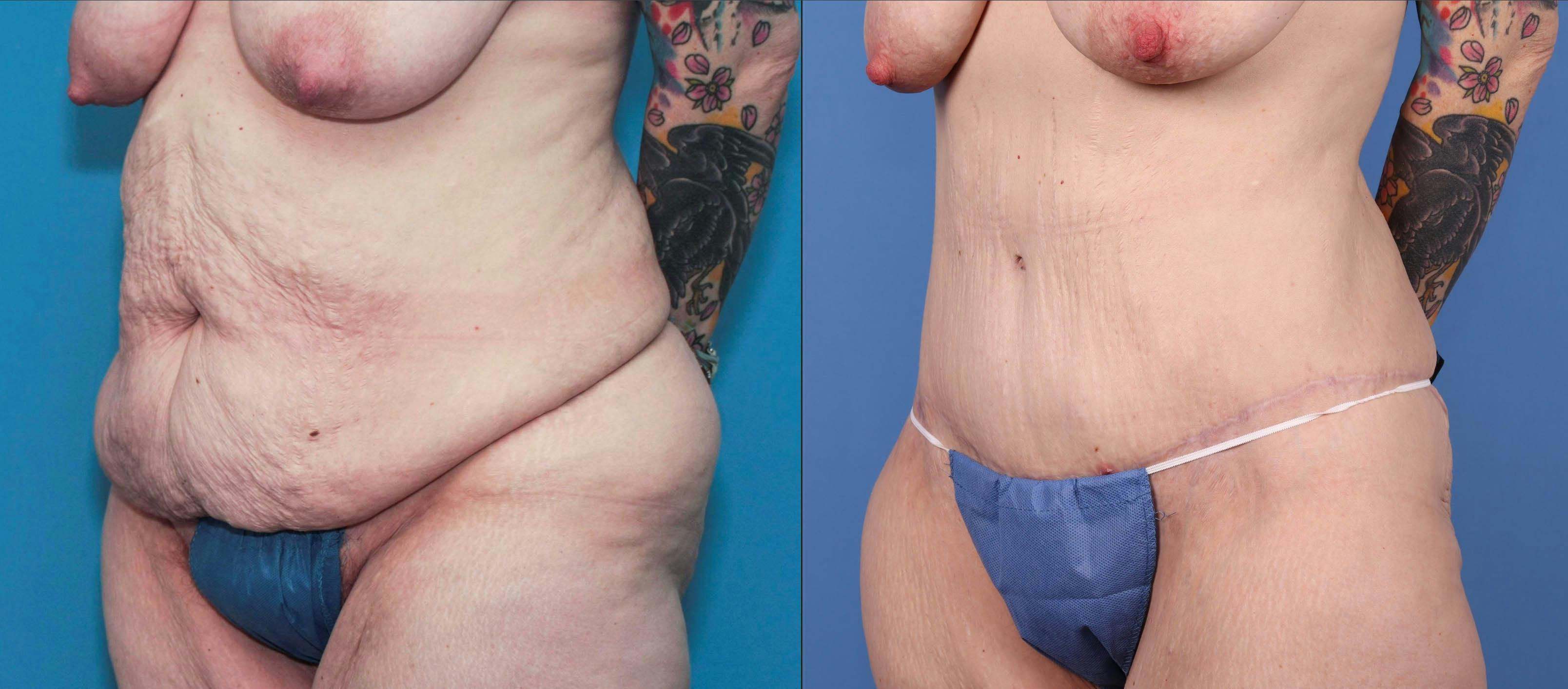 Tummy Tuck Before & After Gallery - Patient 84271123 - Image 2