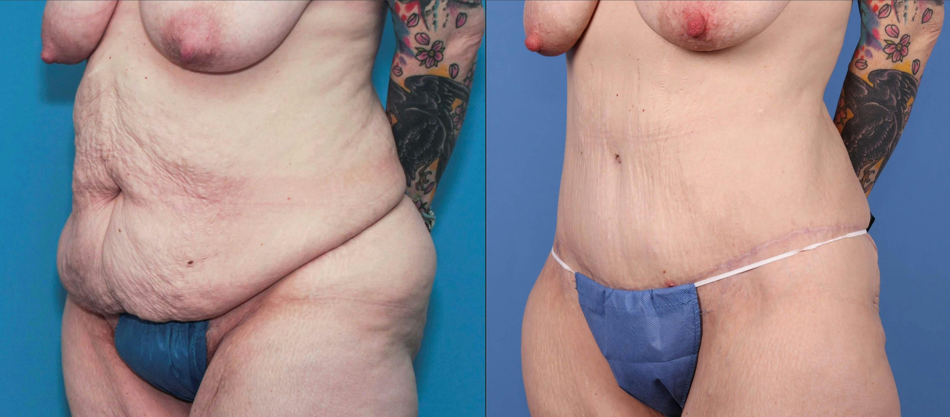 Tummy Tuck Before & After Gallery - Patient 84271116 - Image 2