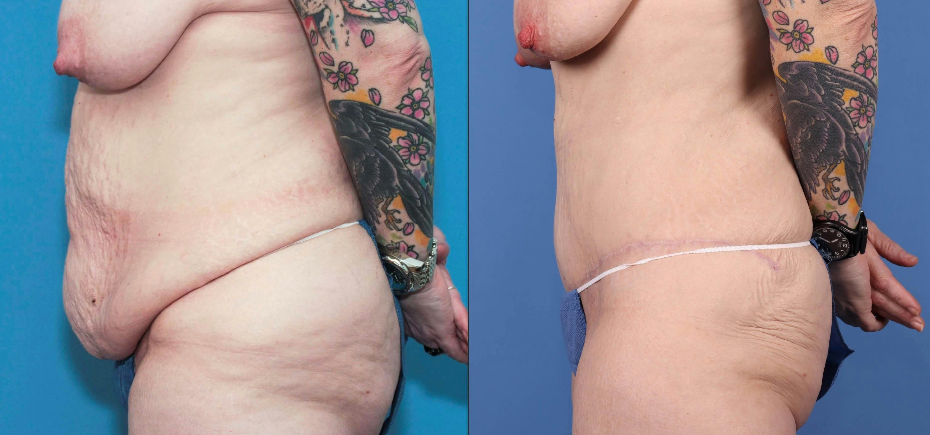 Tummy Tuck Before & After Gallery - Patient 84271123 - Image 3