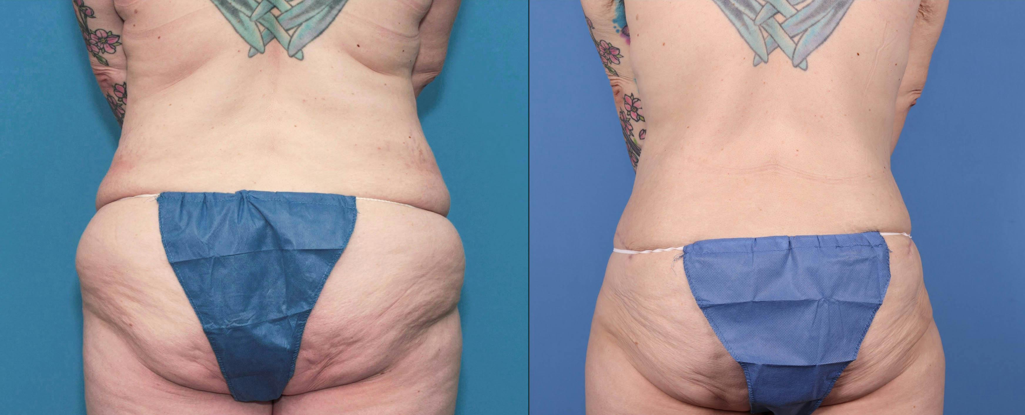 Liposuction Before & After Gallery - Patient 84271181 - Image 1