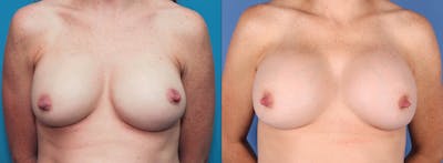 Breast Revision Before & After Gallery - Patient 84617714 - Image 1
