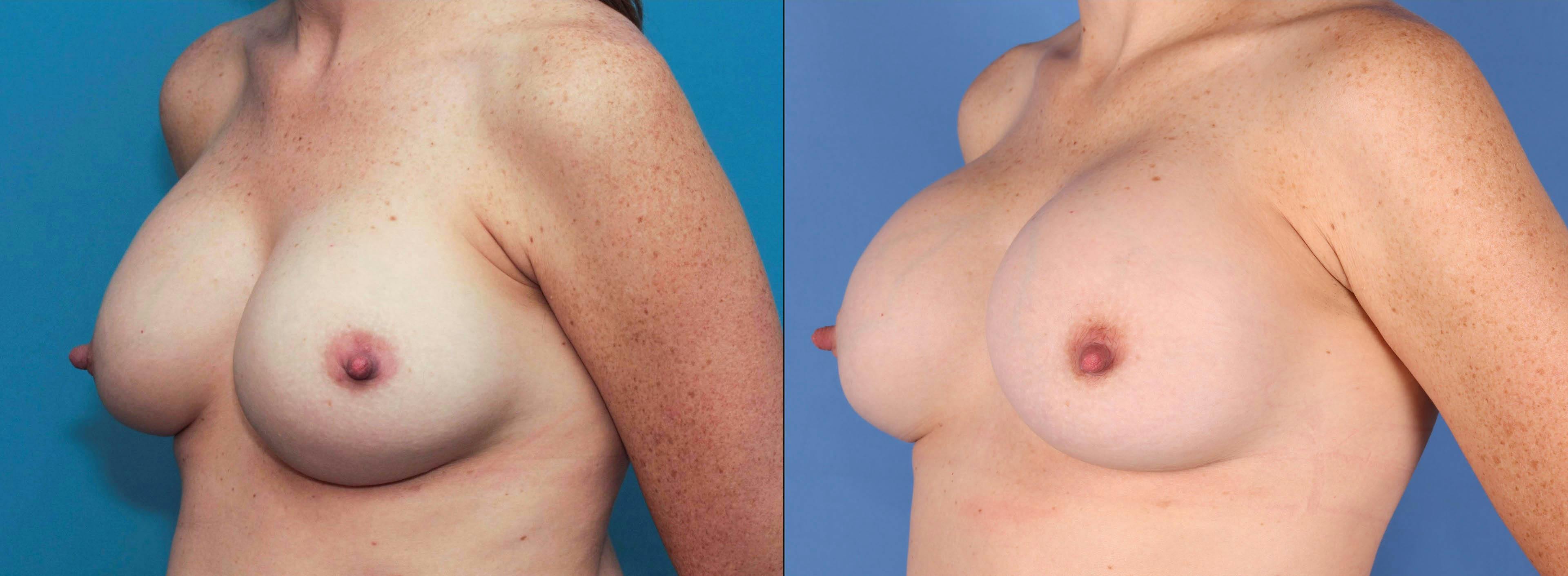 Breast Implant Revision Before & After Gallery - Patient 84617714 - Image 2