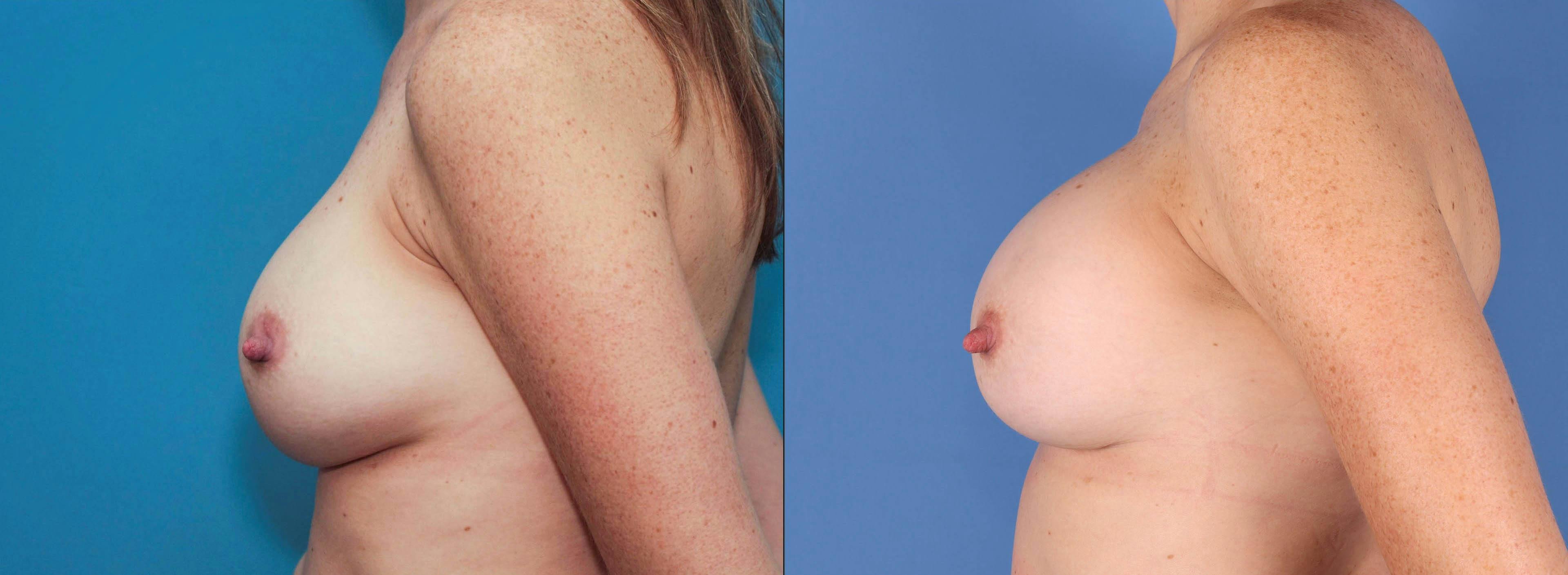 Breast Implant Revision Before & After Gallery - Patient 84617714 - Image 3