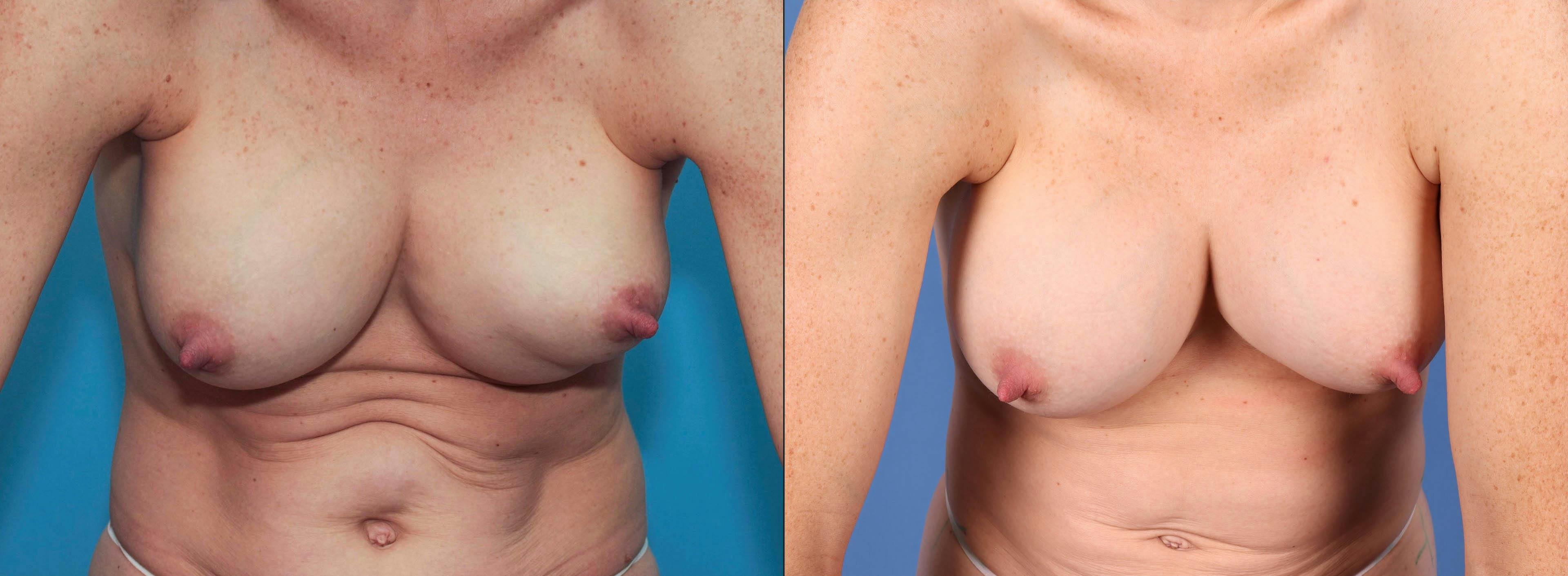 Breast Revision Before & After Gallery - Patient 84617714 - Image 4